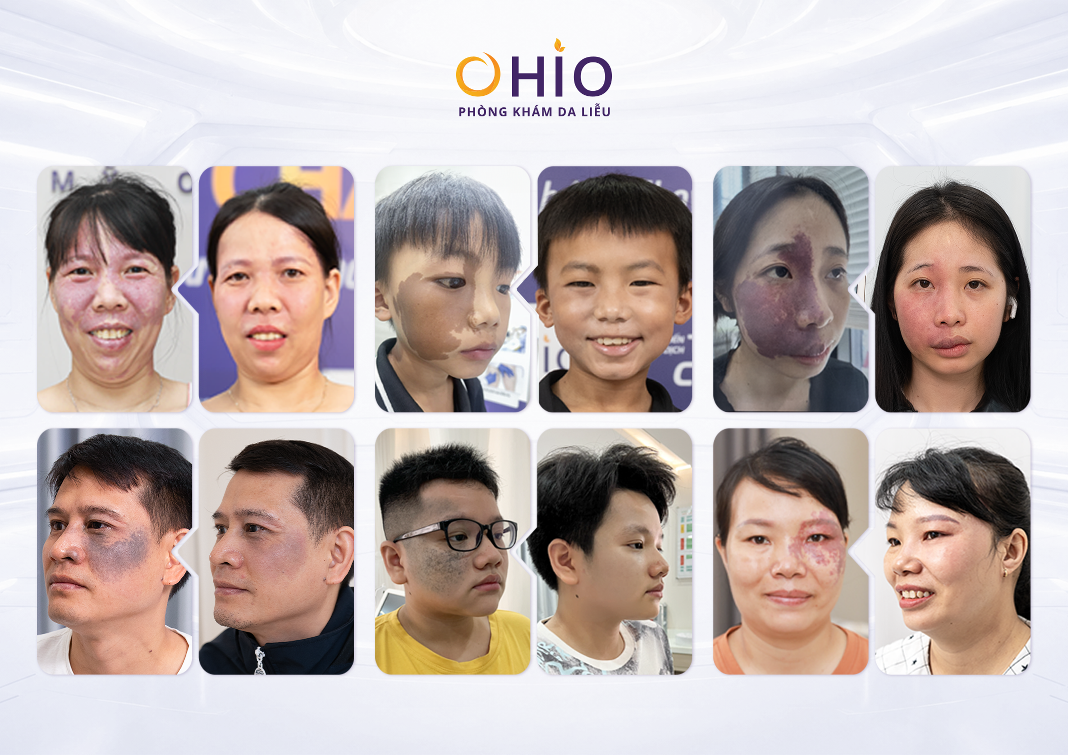 Vì sao OHIO được nhiều khách hàng lựa chọn trong điều trị chàm bớt?