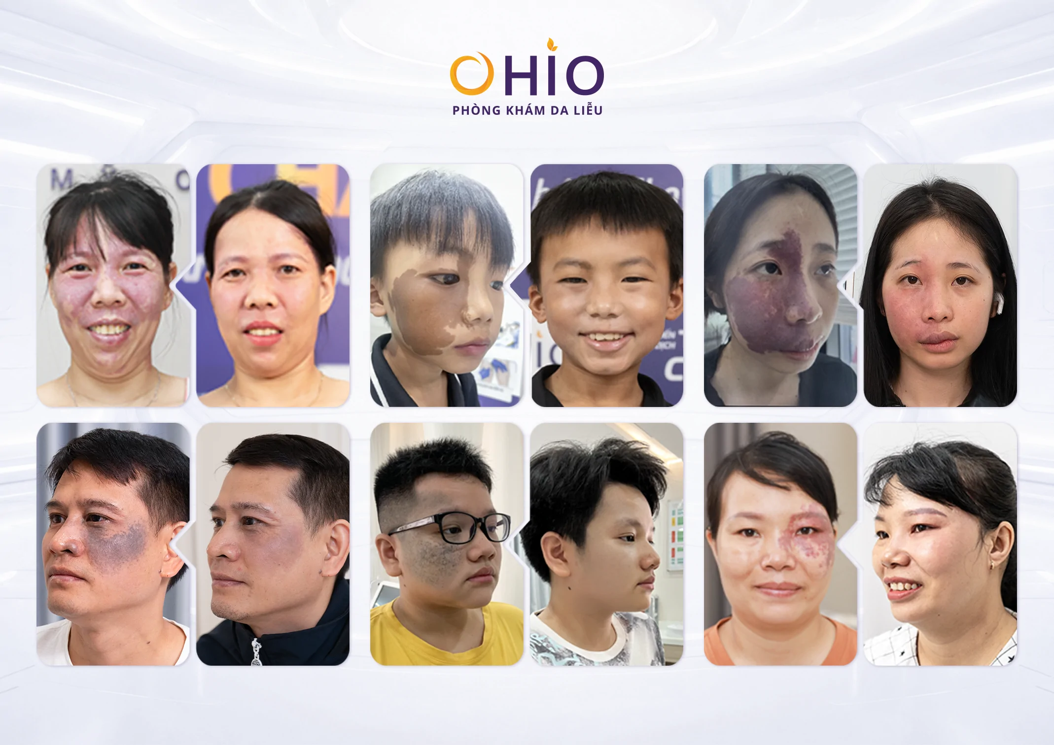 Vì sao OHIO được nhiều khách hàng lựa chọn trong điều trị chàm bớt? - Phòng khám da liễu OHIO Vì sao OHIO được nhiều khách hàng lựa chọn trong điều trị chàm bớt?