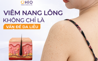 Trị viêm nang lông: Câu chuyện thay đổi Của doanh nhân Thảo Vy - Phòng khám da liễu OHIO Trị viêm nang lông: Câu chuyện thay đổi Của doanh nhân Thảo Vy