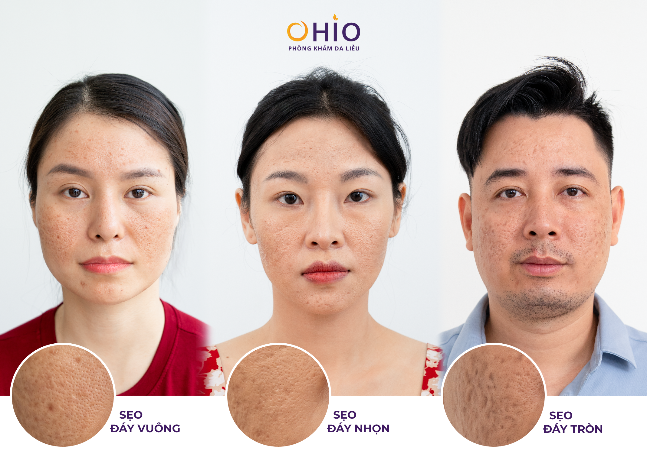 Bác Sĩ Da Liễu Nói Gì Về Xu Hướng Điều Trị Sẹo Rỗ 2026?