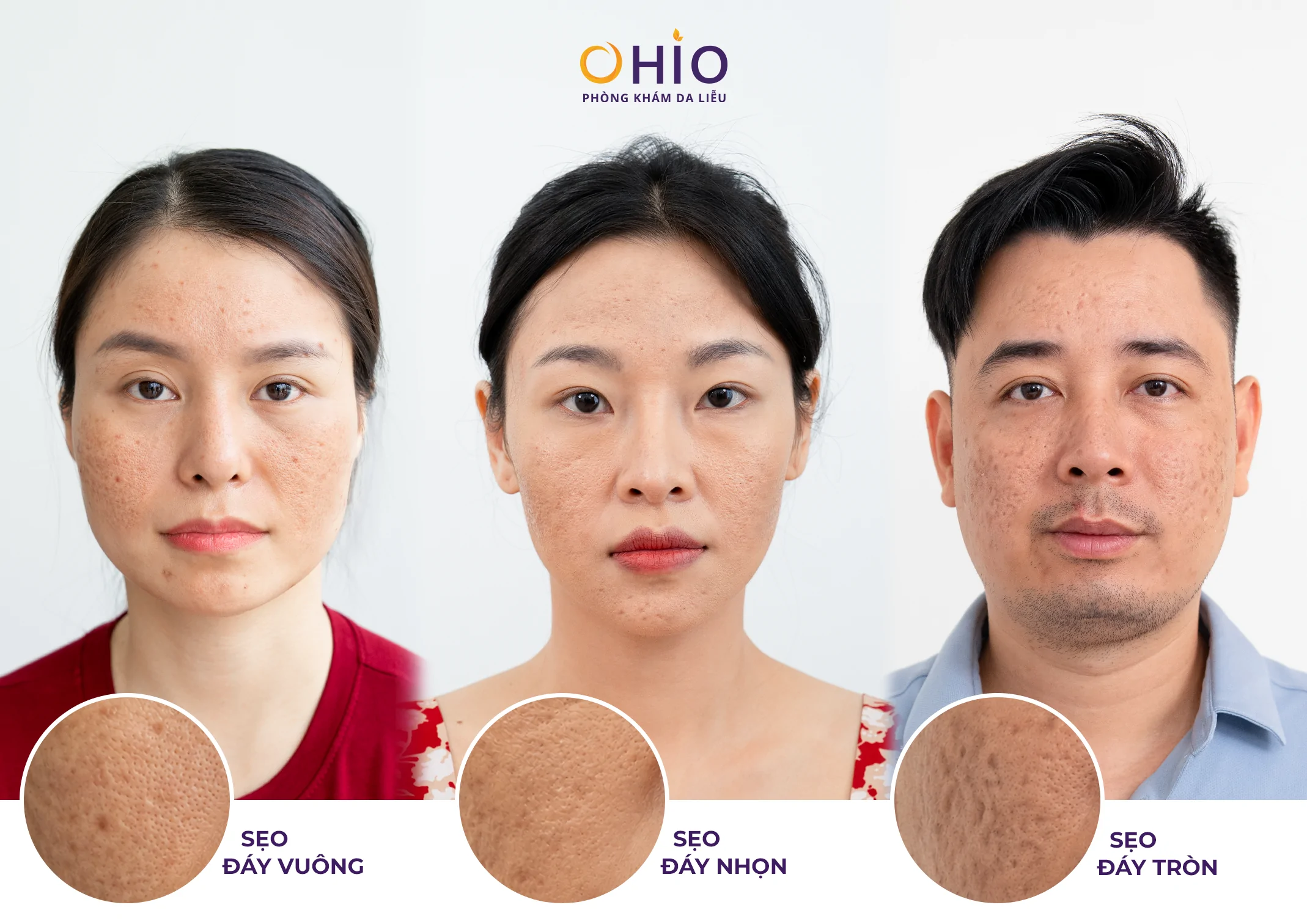 Bác Sĩ Da Liễu Nói Gì Về Xu Hướng Điều Trị Sẹo Rỗ 2026? - Phòng khám da liễu OHIO Bác Sĩ Da Liễu Nói Gì Về Xu Hướng Điều Trị Sẹo Rỗ 2026?