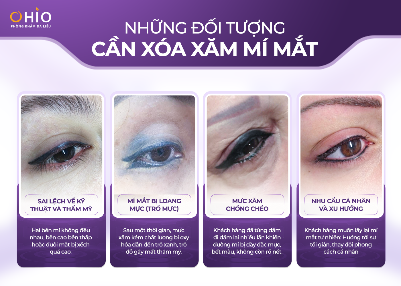 Xóa xăm mí mắt an toàn hiệu quả với phác đồ Pico 3X - Phòng khám da liễu OHIO Xóa xăm mí mắt an toàn hiệu quả với phác đồ Pico 3X
