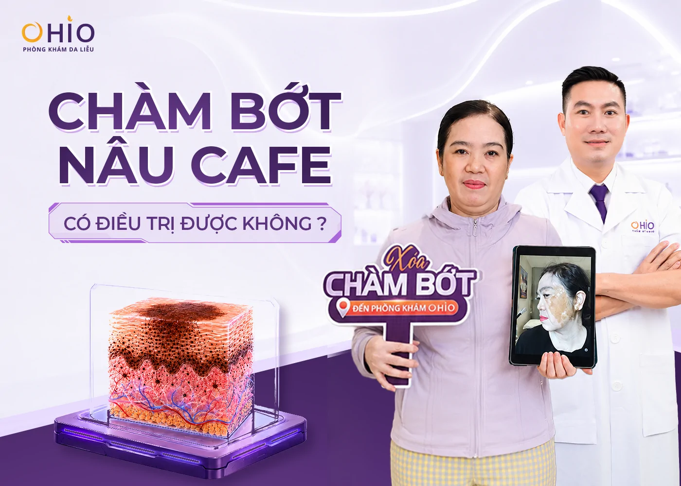 Chàm bớt nâu cafe có điều trị được không? Giải đáp từ Bác sĩ Da liễu - Phòng khám da liễu OHIO Chàm bớt nâu cafe có điều trị được không