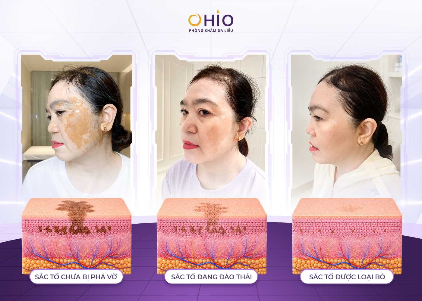 Chàm bớt nâu cafe có điều trị được không? Giải đáp từ Bác sĩ Da liễu - Phòng khám da liễu OHIO Chàm bớt nâu cafe có điều trị được không? Giải đáp từ Bác sĩ Da liễu