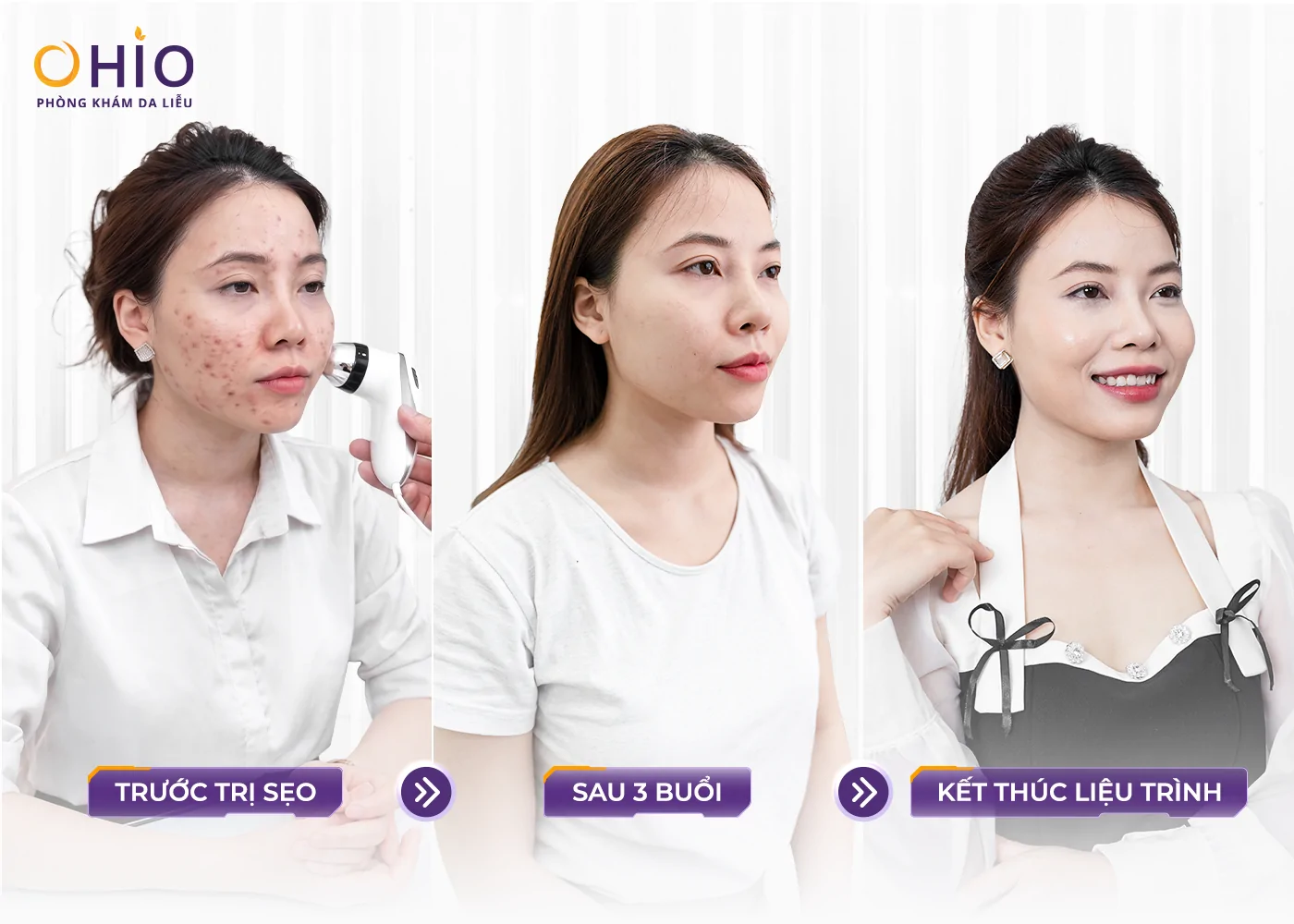 Hành Trình Thay Đổi Của Nữ Luật Sư 30 Tuổi - “Tôi Từng Né Nhìn Thẳng Vào Khách Hàng Chỉ Vì Sẹo Rỗ” - Phòng khám da liễu OHIO Hành Trình Thay Đổi Của Nữ Luật Sư 30 Tuổi - “Tôi Từng Né Nhìn Thẳng Vào Khách Hàng Chỉ Vì Sẹo Rỗ”