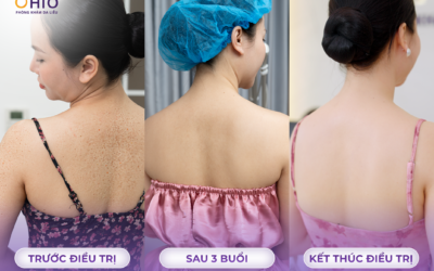 Trị viêm nang lông: Câu chuyện thay đổi Của doanh nhân Thảo Vy