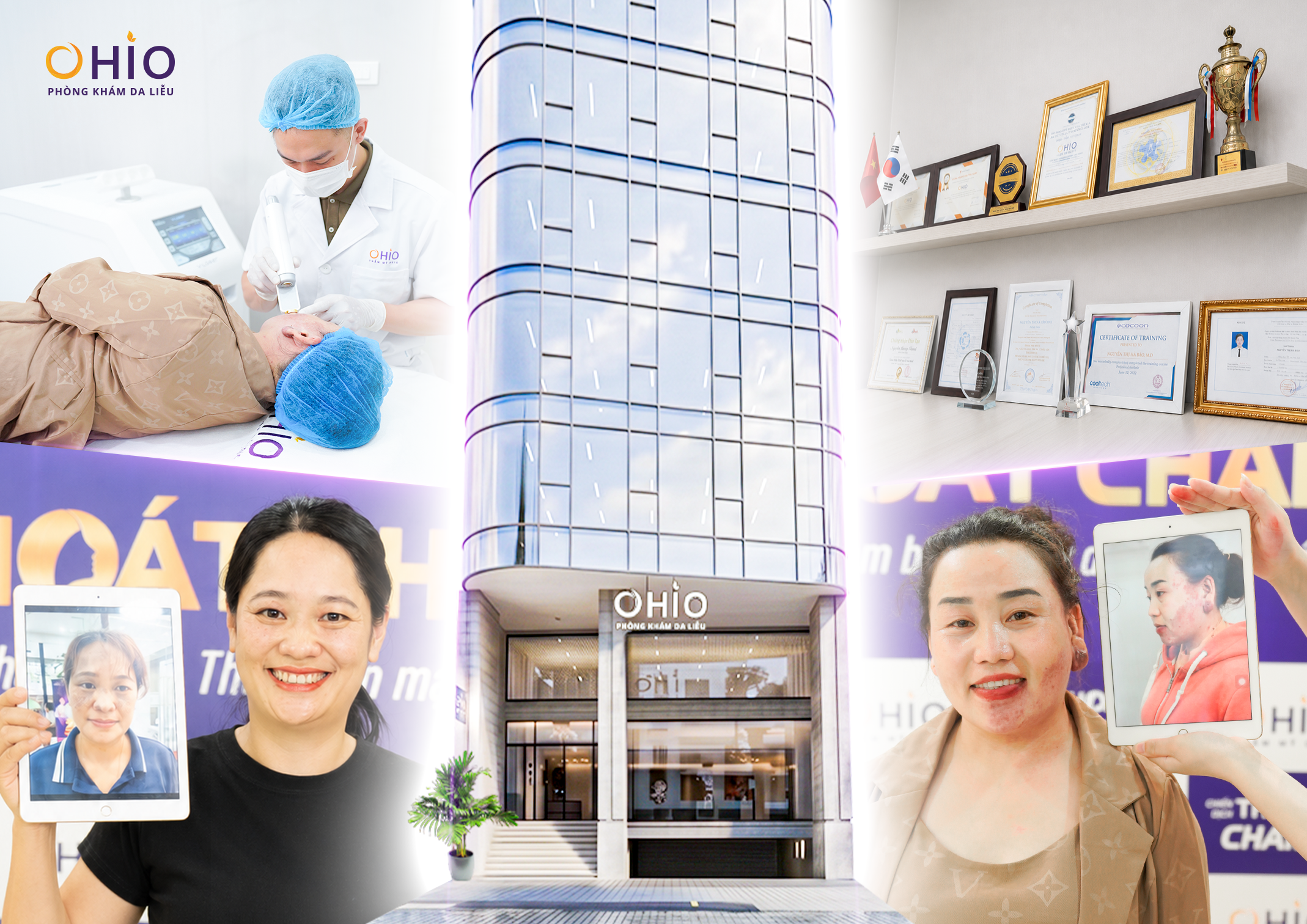 Vì sao OHIO được nhiều khách hàng lựa chọn trong điều trị chàm bớt?