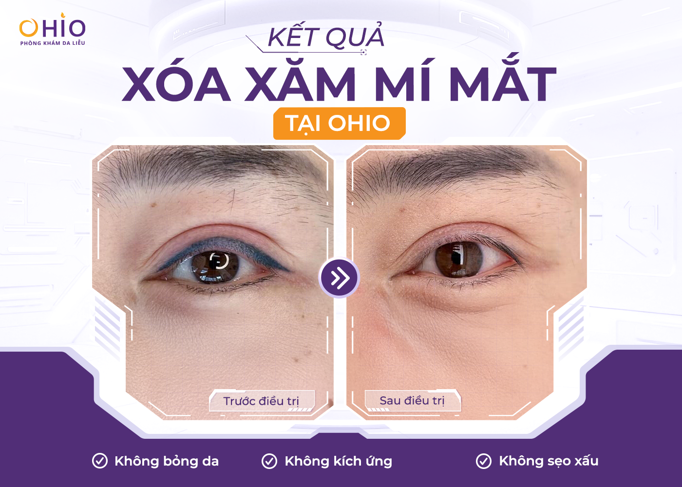 Xóa xăm mí mắt an toàn hiệu quả với phác đồ Pico 3X - Phòng khám da liễu OHIO Xóa xăm mí mắt an toàn hiệu quả với phác đồ Pico 3X