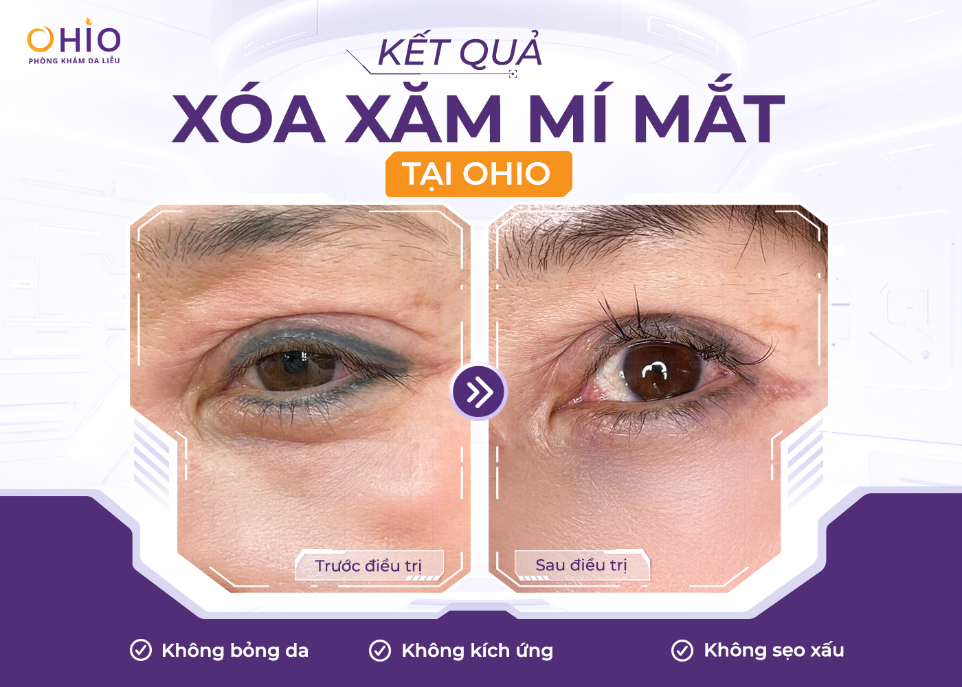 Xóa xăm mí mắt an toàn hiệu quả với phác đồ Pico 3X - Phòng khám da liễu OHIO Xóa xăm mí mắt an toàn hiệu quả với phác đồ Pico 3X