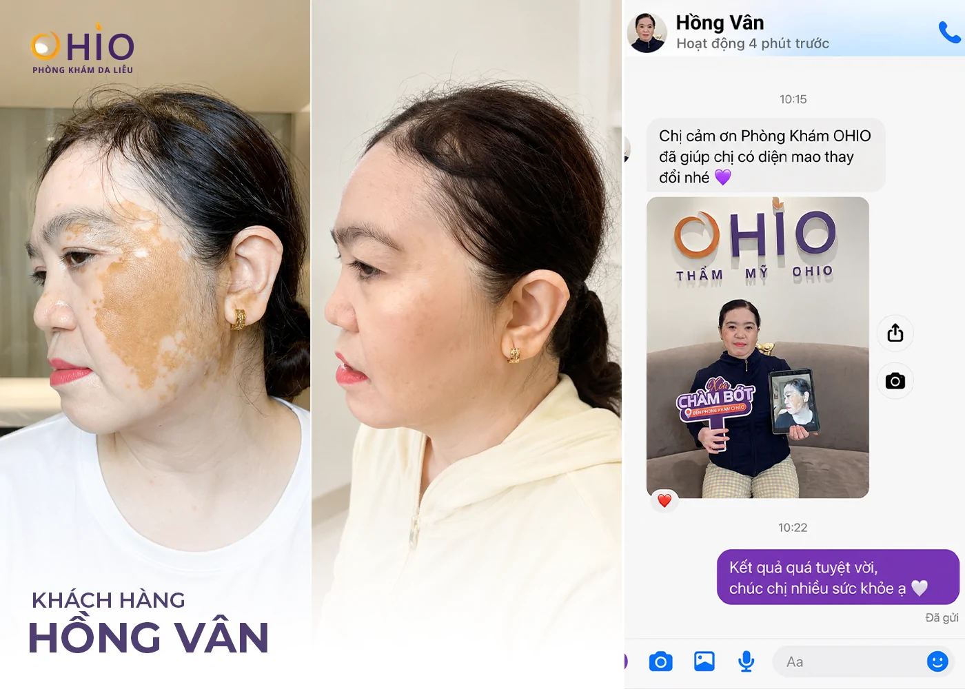 Chàm bớt nâu cafe có điều trị được không? Giải đáp từ Bác sĩ Da liễu - Phòng khám da liễu OHIO Chàm bớt nâu cafe có điều trị được không? Giải đáp từ Bác sĩ Da liễu
