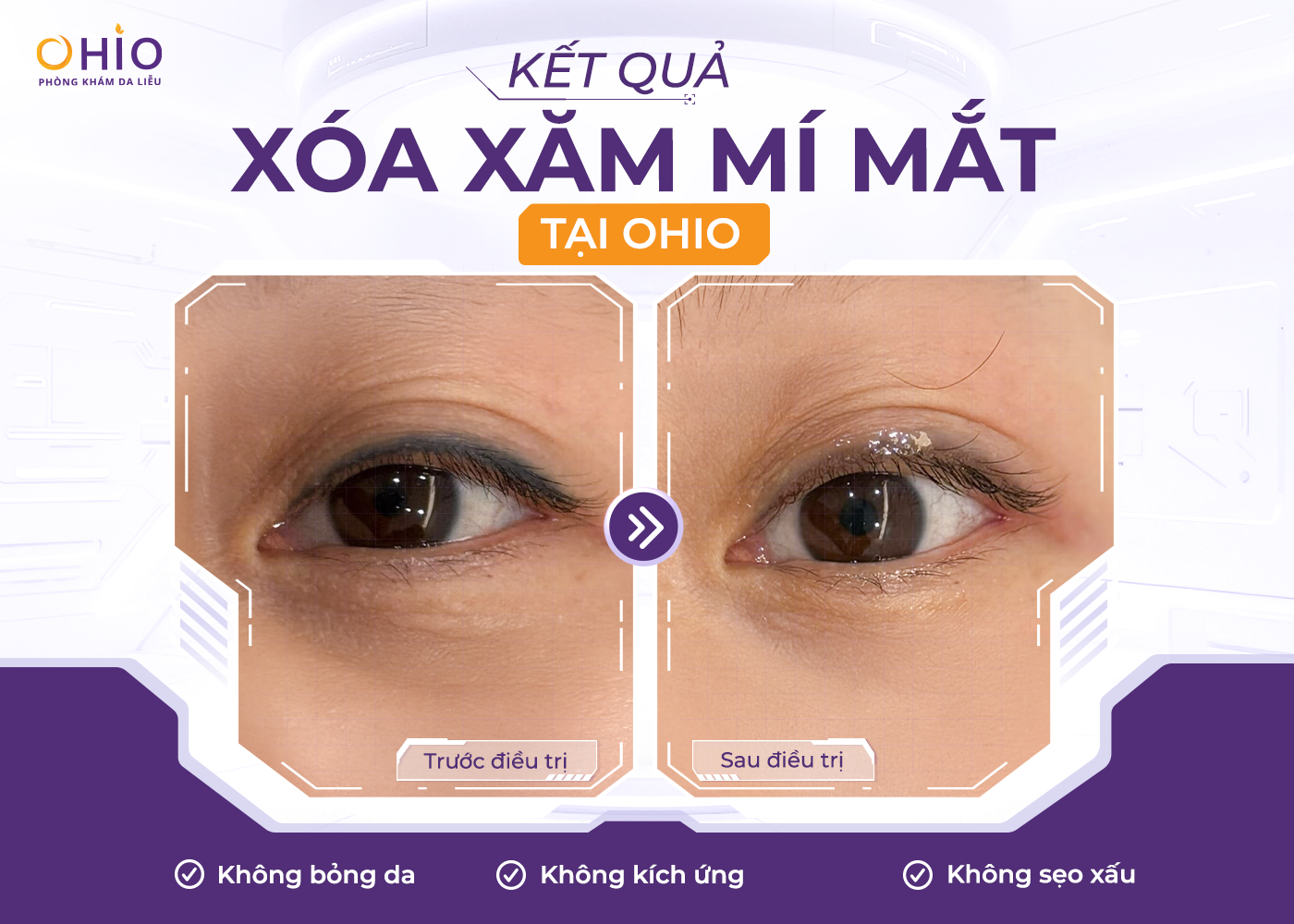 Xóa xăm mí mắt an toàn hiệu quả với phác đồ Pico 3X - Phòng khám da liễu OHIO Xóa xăm mí mắt an toàn hiệu quả với phác đồ Pico 3X