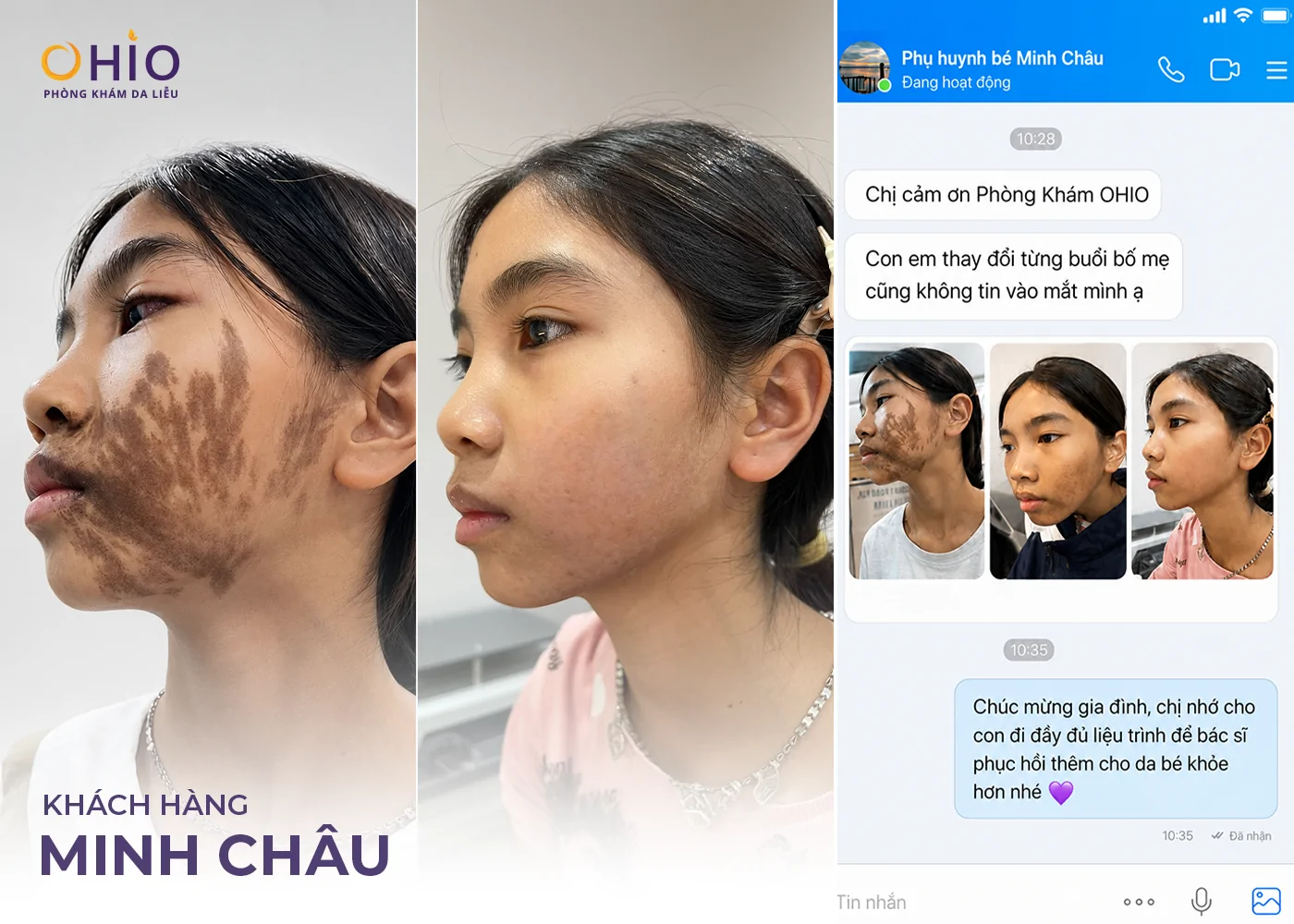 Chàm bớt nâu cafe có điều trị được không? Giải đáp từ Bác sĩ Da liễu - Phòng khám da liễu OHIO Chàm bớt nâu cafe có điều trị được không? Giải đáp từ Bác sĩ Da liễu