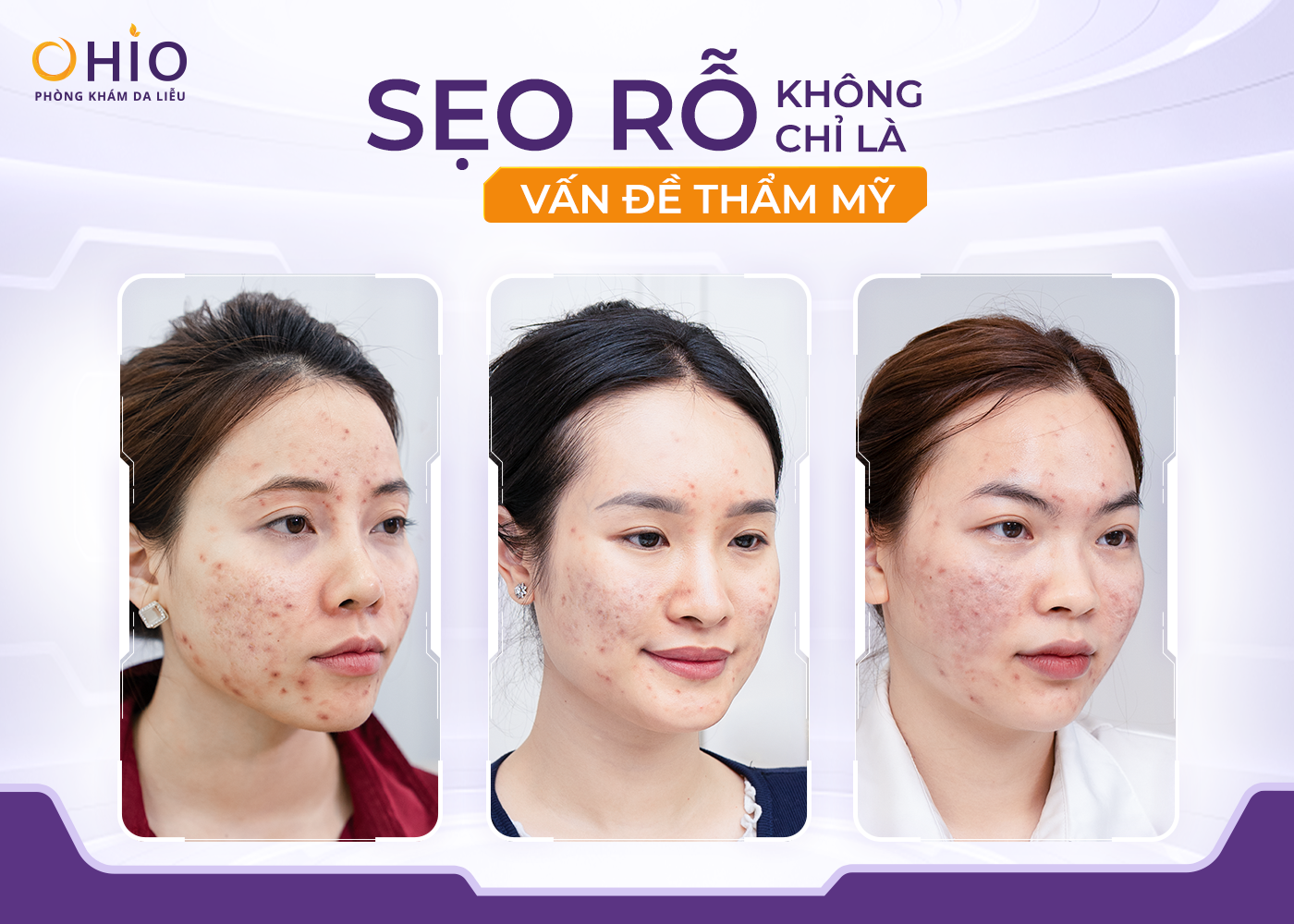 OHIO Và Hướng Đi Mới Trong Điều Trị Sẹo Rỗ: Không Chỉ Làm Đầy Sẹo, Mà Tái Sinh Sự Tự Tin - Phòng khám da liễu OHIO Điều Trị Sẹo Rỗ