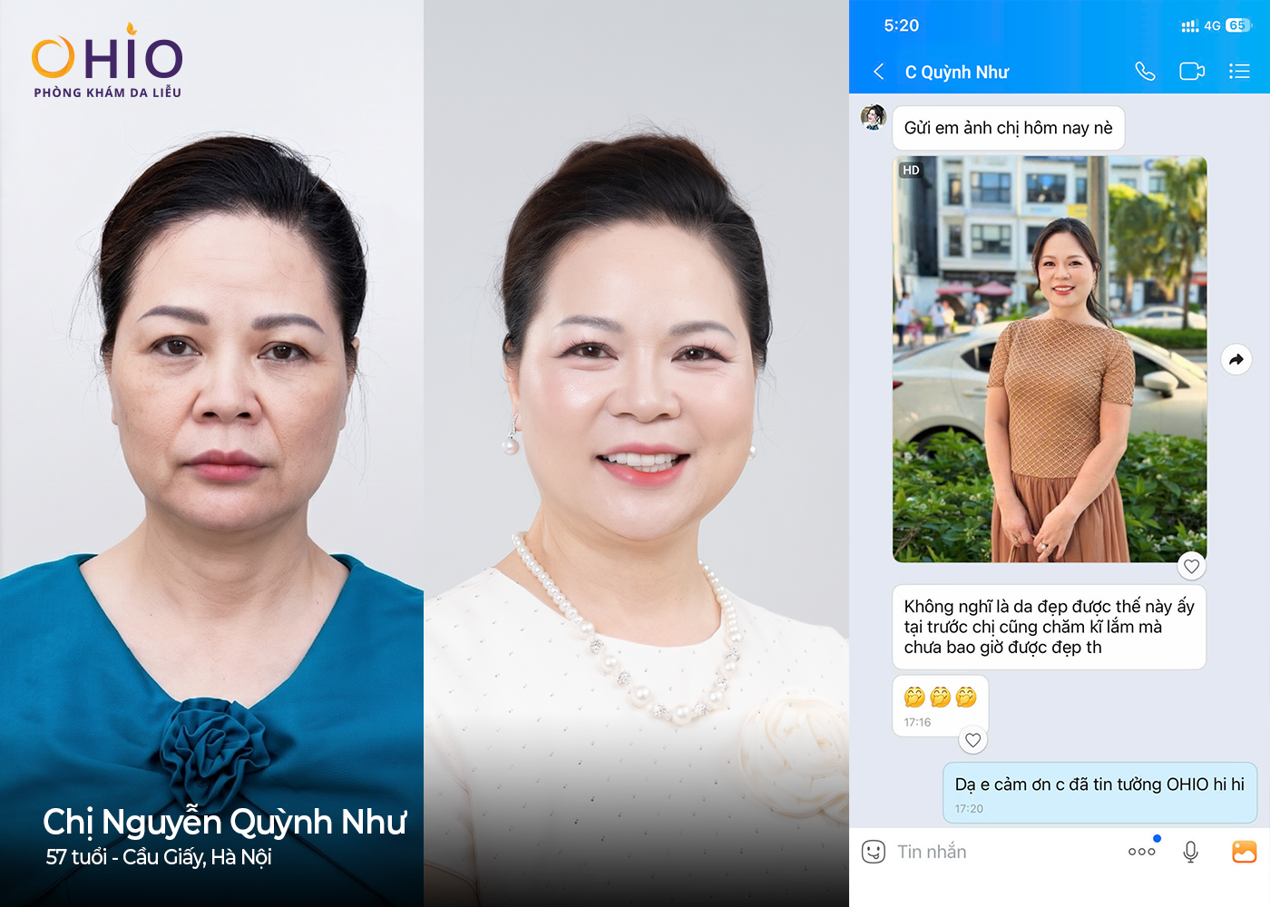 Trẻ hóa da không xâm lấn: Hành trình tìm lại nhan sắc ở tuổi 57 của hoa khôi - Phòng khám da liễu OHIO Trẻ hóa da không xâm lấn: Hành trình tìm lại nhan sắc ở tuổi 57 của hoa khôi