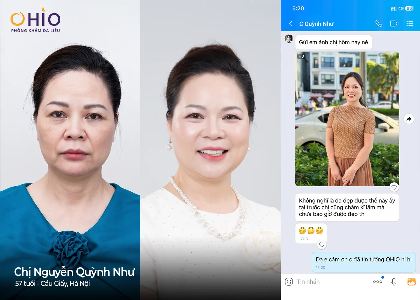 Trẻ hóa da không xâm lấn: Hành trình tìm lại nhan sắc ở tuổi 57 của hoa khôi - Phòng khám da liễu OHIO Trẻ hóa da không xâm lấn: Hành trình tìm lại nhan sắc ở tuổi 57 của hoa khôi