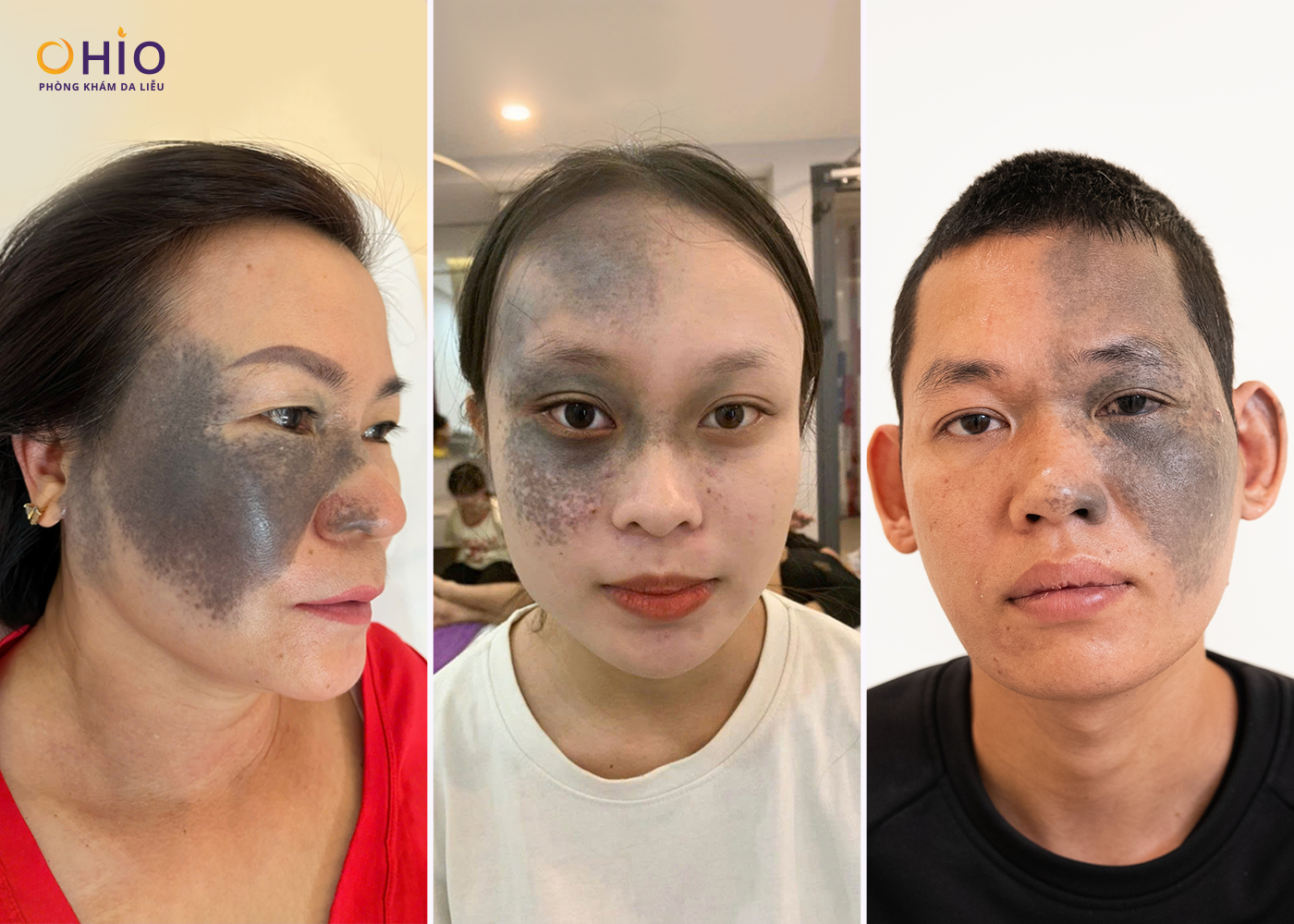 Chàm bớt OTA là gì? Nguyên nhân hình thành và phương pháp điều trị hiện nay