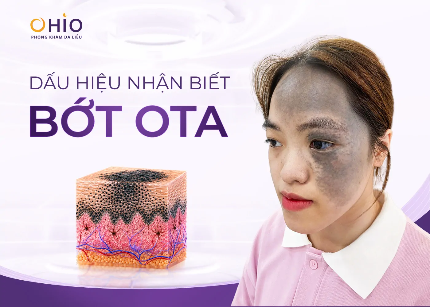 Chàm bớt OTA là gì? Nguyên nhân hình thành và phương pháp điều trị hiện nay - Phòng khám da liễu OHIO Chàm bớt OTA là gì? Nguyên nhân hình thành và phương pháp điều trị hiện nay