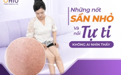 Hành trình thoát khỏi sự tự ti viêm nang lông của nữ doanh nhân Minh Thư - Phòng khám da liễu OHIO Hành trình thoát khỏi sự tự ti viêm nang lông của nữ doanh nhân Minh Thư