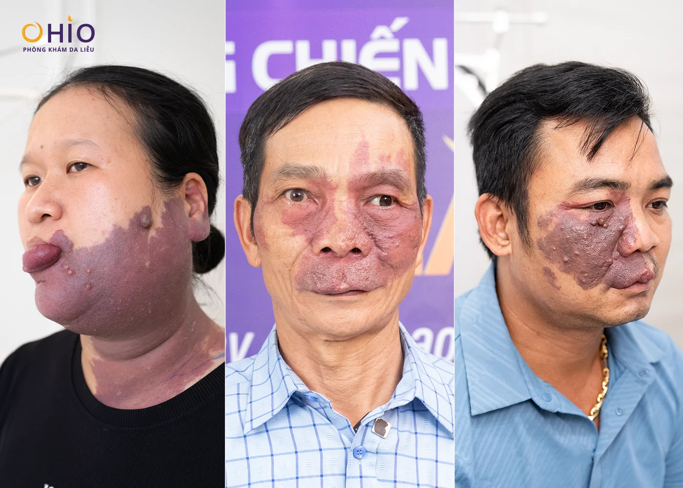U Máu Là Gì? Dấu Hiệu Nhận Biết, Nguyên Nhân Và Phương Pháp Điều Trị Hiện Nay - Phòng khám da liễu OHIO U Máu Là Gì? Dấu Hiệu Nhận Biết, Nguyên Nhân Và Phương Pháp Điều Trị Hiện Nay