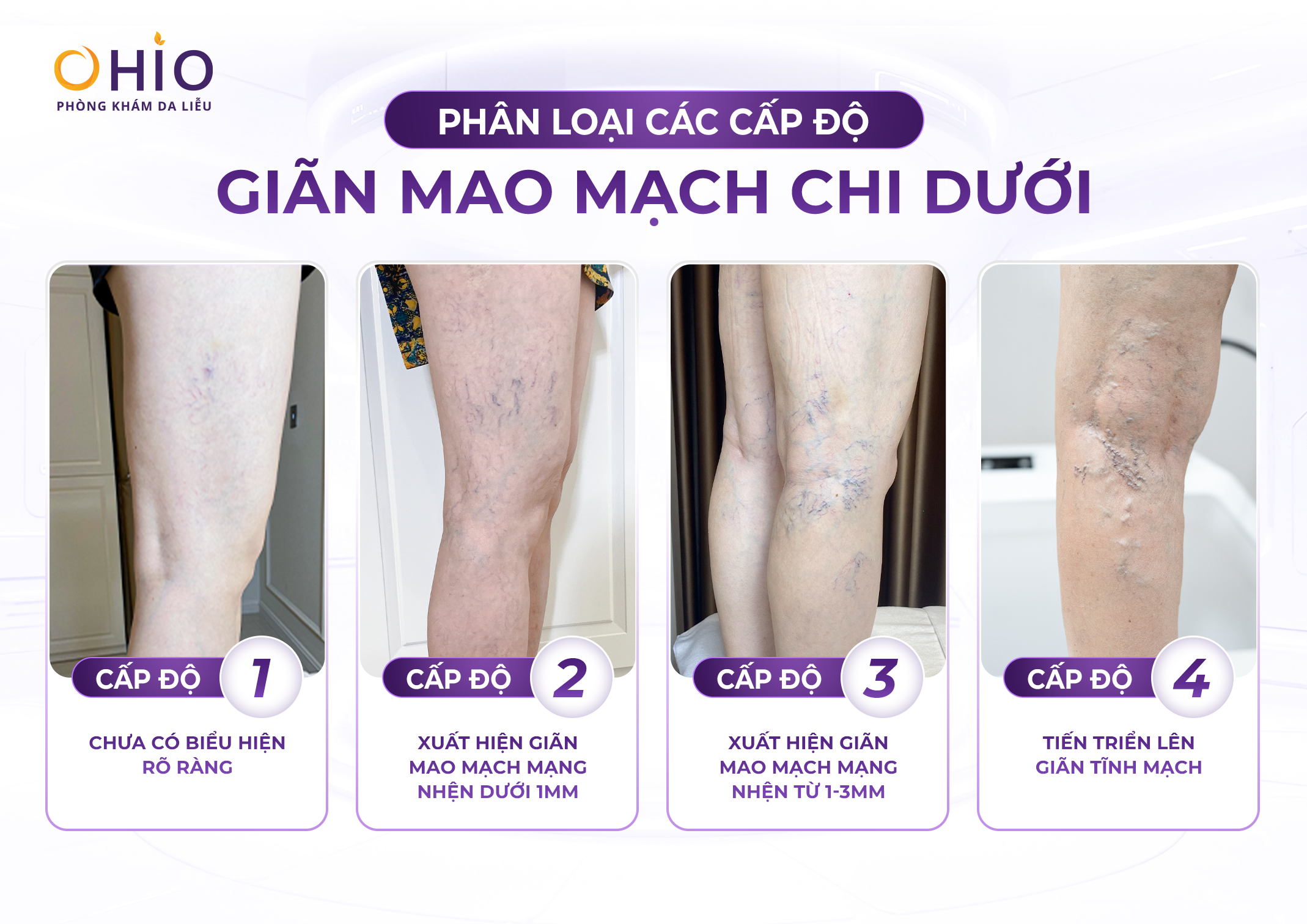 Giãn mao mạch ở chân có tự khỏi không? Giải đáp từ bác sĩ da liễu