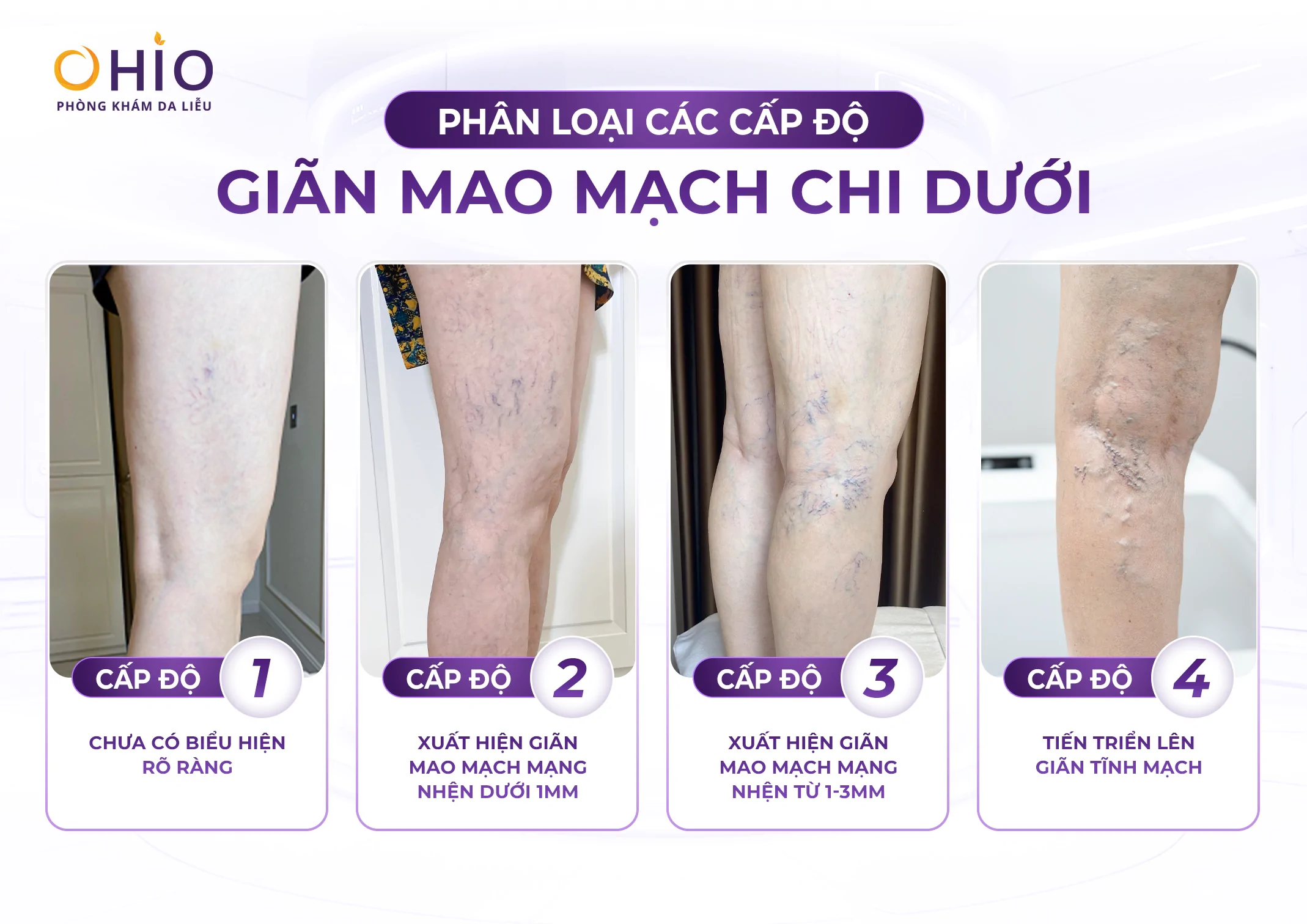 Giãn mao mạch ở chân có tự khỏi không? Giải đáp từ bác sĩ da liễu - Phòng khám da liễu OHIO Giãn mao mạch ở chân có tự khỏi không? Giải đáp từ bác sĩ da liễu