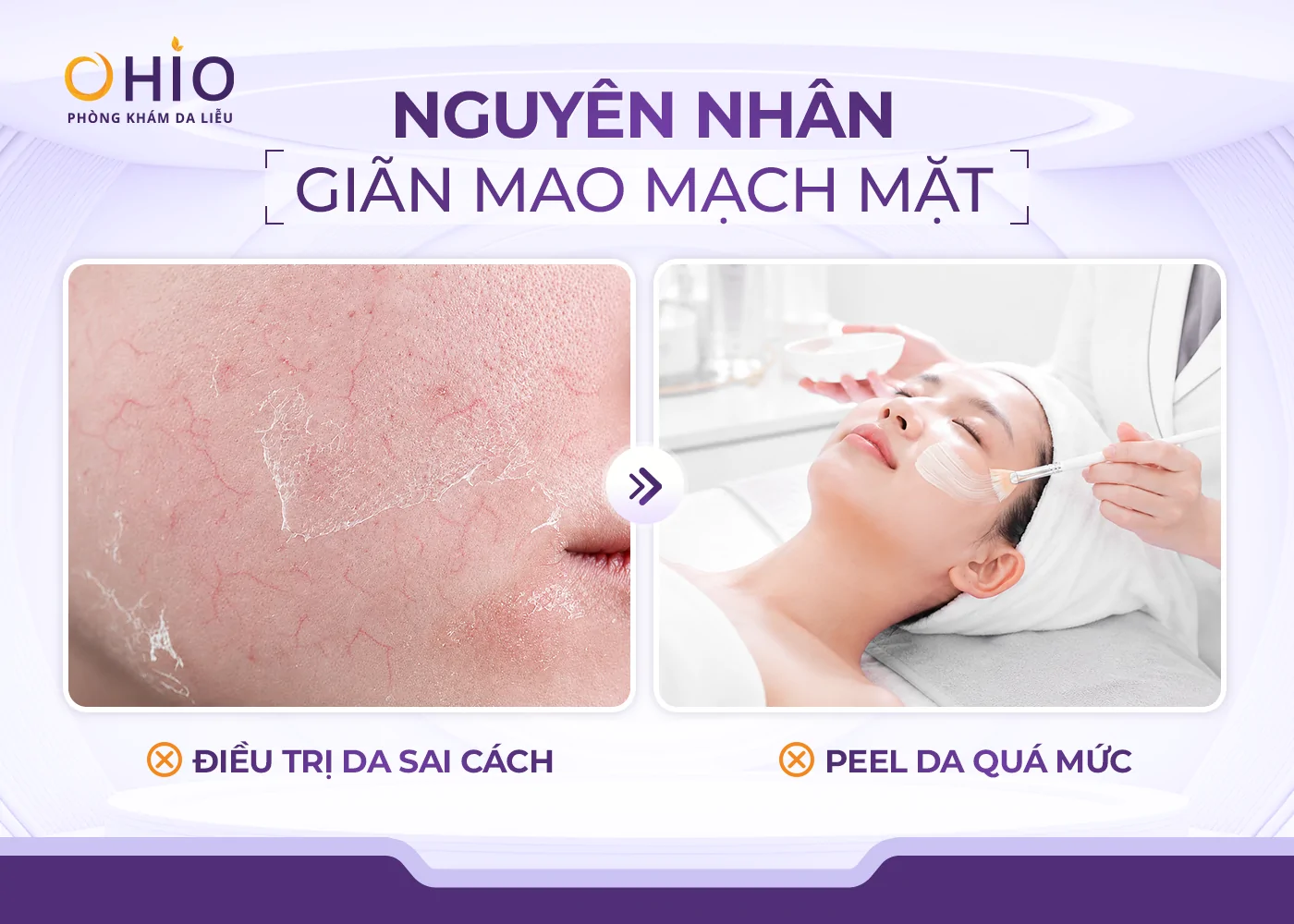 Giãn mao mạch ở mặt: Nguyên nhân, dấu hiệu và phương pháp điều trị hiệu quả - Phòng khám da liễu OHIO nguyên nhân giãn mao mạch mặt