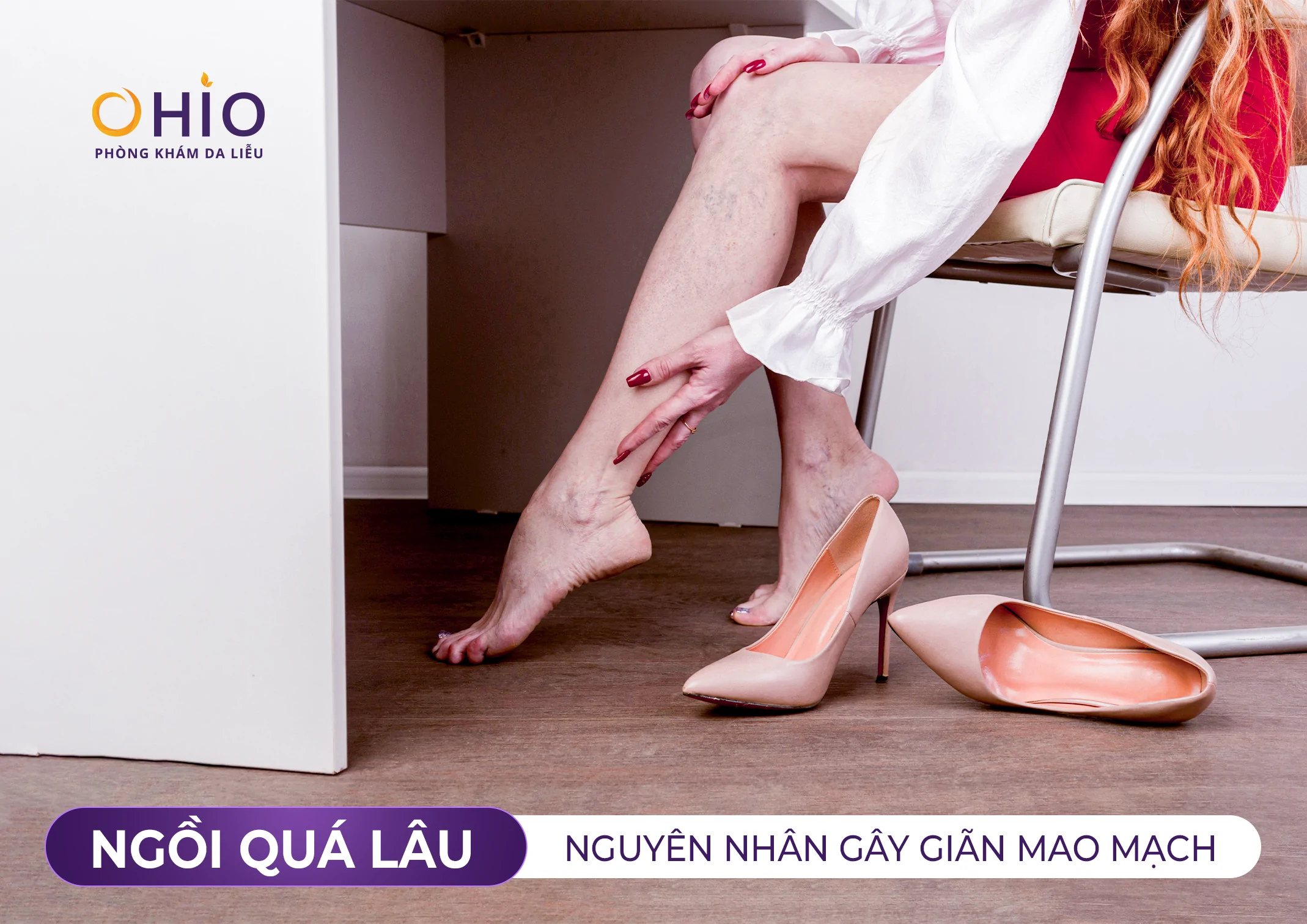 Giãn mao mạch ở chân có tự khỏi không? Giải đáp từ bác sĩ da liễu - Phòng khám da liễu OHIO Giãn mao mạch ở chân có tự khỏi không? Giải đáp từ bác sĩ da liễu