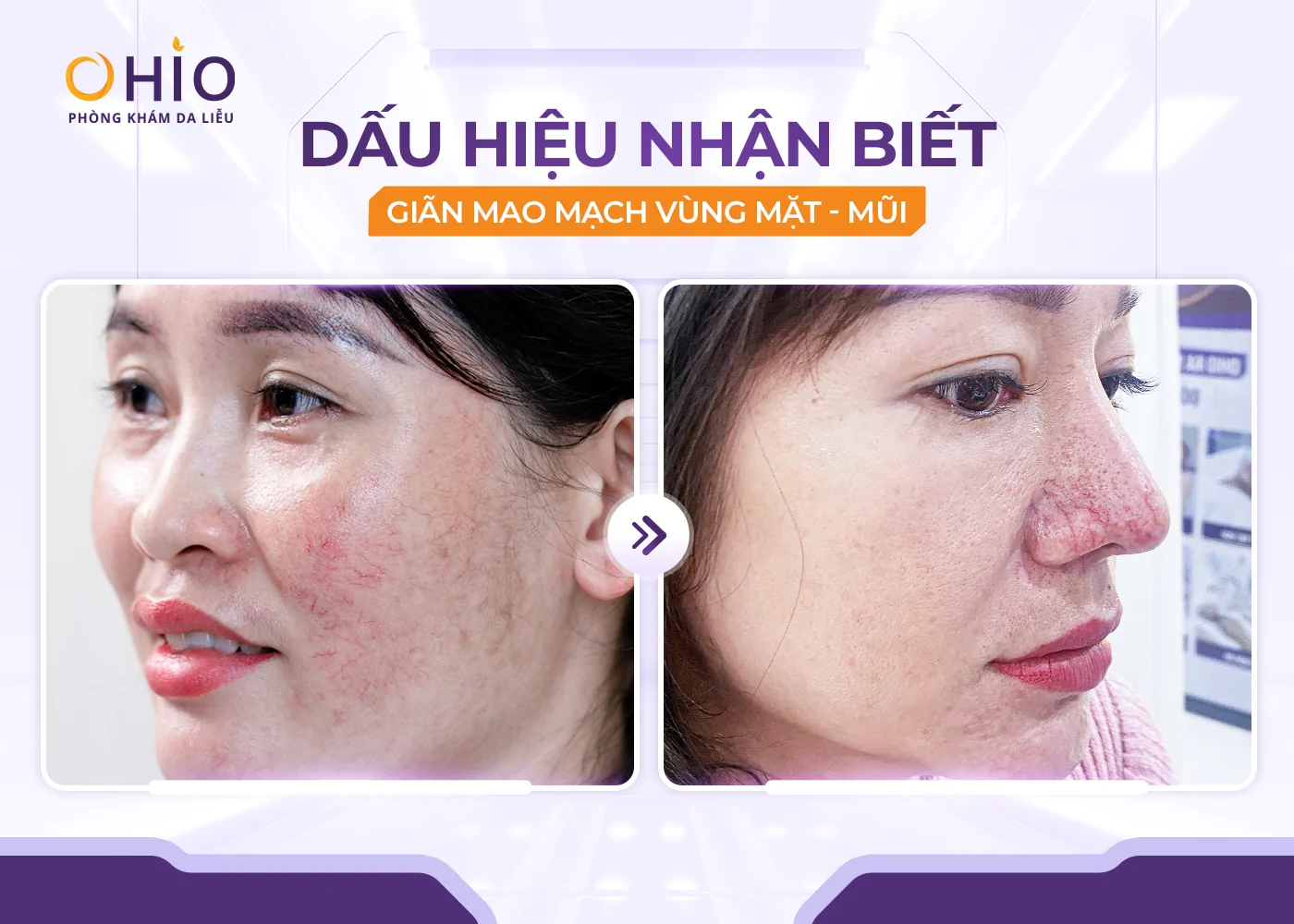 Giãn mao mạch ở mặt: Nguyên nhân, dấu hiệu và phương pháp điều trị hiệu quả - Phòng khám da liễu OHIO Giãn mao mạch ở mặt: Nguyên nhân, dấu hiệu và phương pháp điều trị hiệu quả