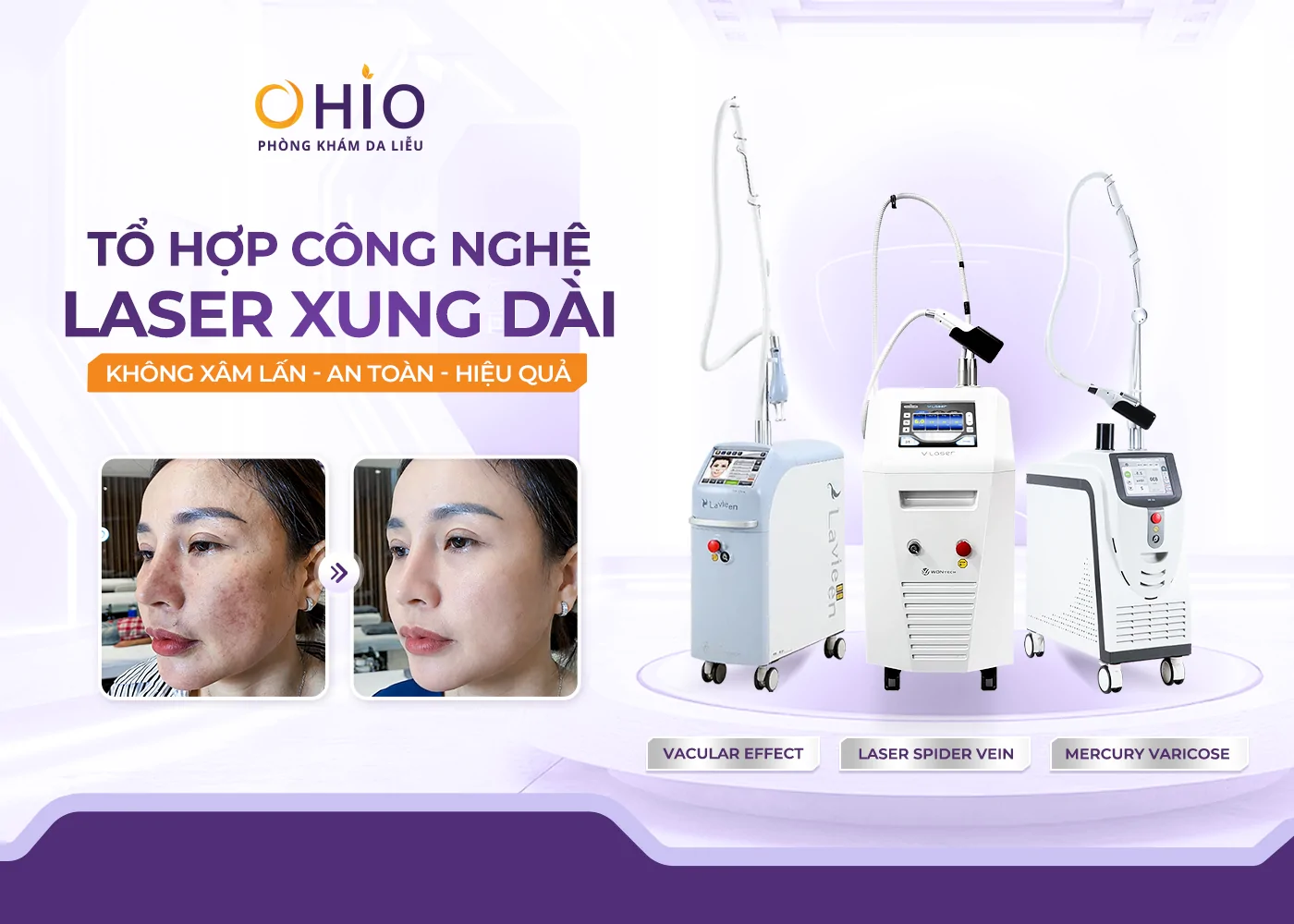 Giãn mao mạch ở mặt: Nguyên nhân, dấu hiệu và phương pháp điều trị hiệu quả - Phòng khám da liễu OHIO Giãn mao mạch ở mặt: Nguyên nhân, dấu hiệu và phương pháp điều trị hiệu quả