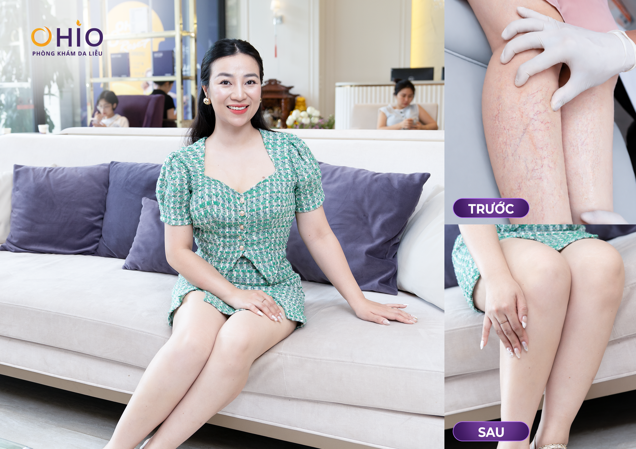 Giãn mao mạch ở chân có tự khỏi không? Giải đáp từ bác sĩ da liễu