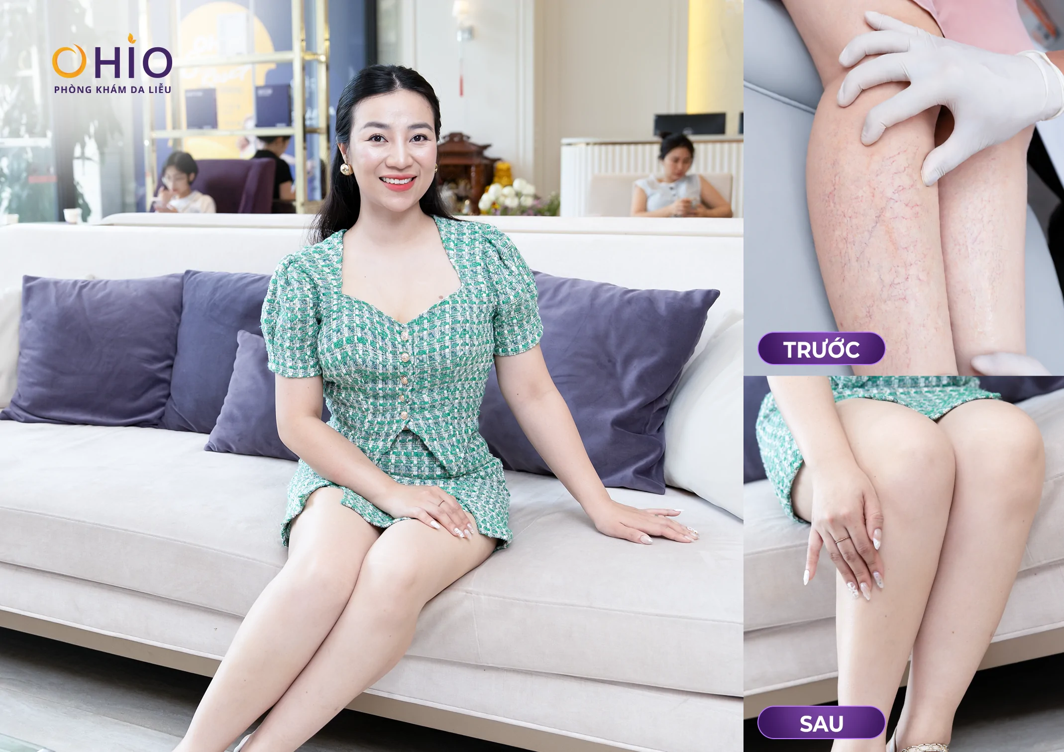Giãn mao mạch ở chân có tự khỏi không? Giải đáp từ bác sĩ da liễu - Phòng khám da liễu OHIO Giãn mao mạch ở chân có tự khỏi không? Giải đáp từ bác sĩ da liễu