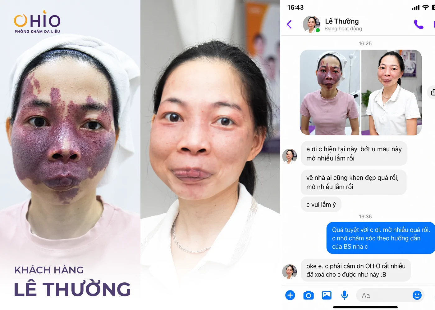 U Máu Là Gì? Dấu Hiệu Nhận Biết, Nguyên Nhân Và Phương Pháp Điều Trị Hiện Nay - Phòng khám da liễu OHIO U Máu Là Gì? Dấu Hiệu Nhận Biết, Nguyên Nhân Và Phương Pháp Điều Trị Hiện Nay