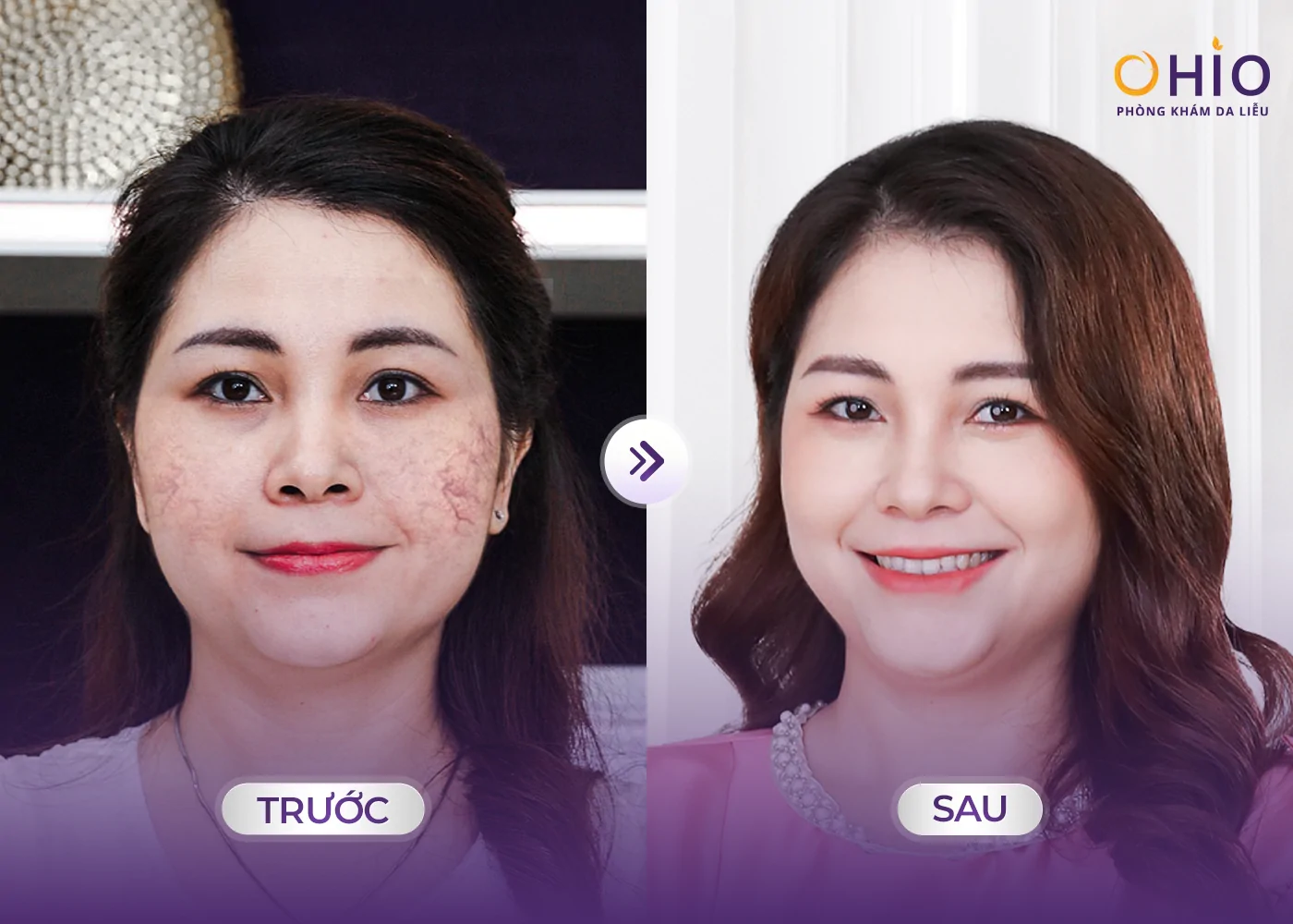 Giãn mao mạch ở mặt: Nguyên nhân, dấu hiệu và phương pháp điều trị hiệu quả - Phòng khám da liễu OHIO Giãn mao mạch ở mặt: Nguyên nhân, dấu hiệu và phương pháp điều trị hiệu quả