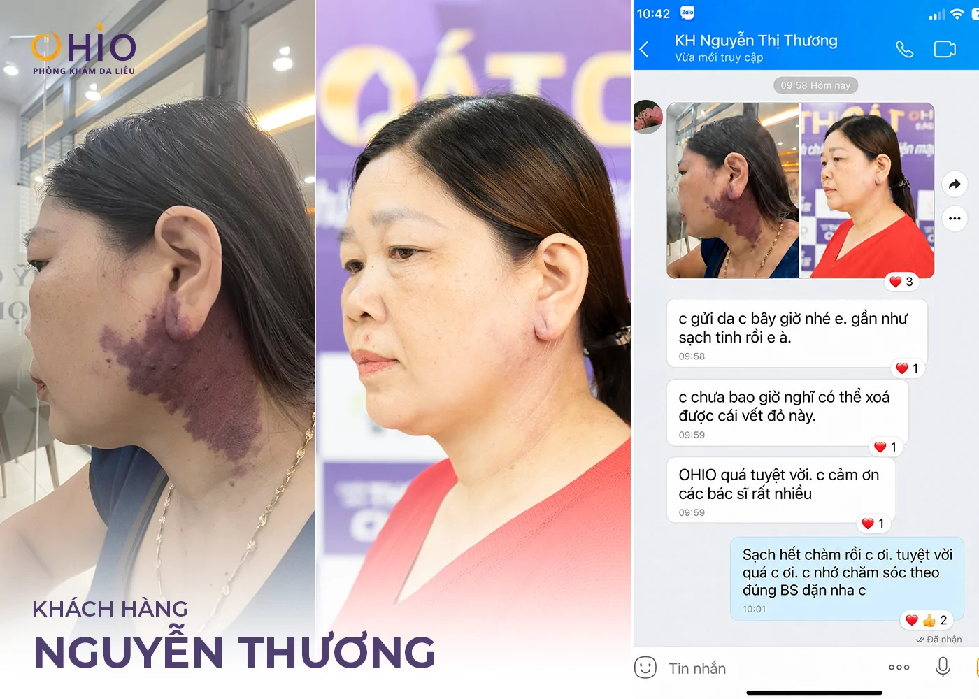 U Máu Là Gì? Dấu Hiệu Nhận Biết, Nguyên Nhân Và Phương Pháp Điều Trị Hiện Nay - Phòng khám da liễu OHIO U Máu Là Gì? Dấu Hiệu Nhận Biết, Nguyên Nhân Và Phương Pháp Điều Trị Hiện Nay