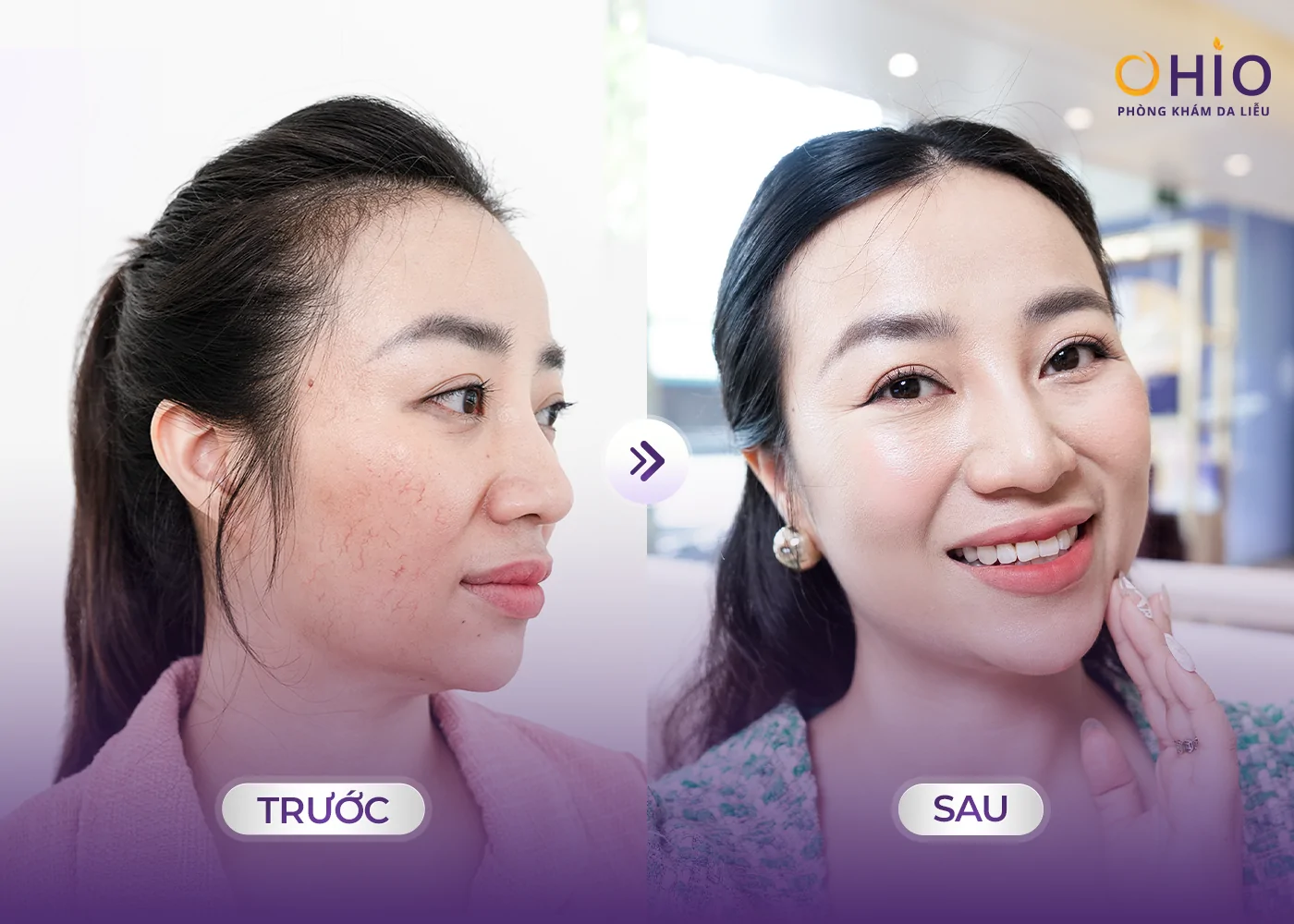 Giãn mao mạch ở mặt: Nguyên nhân, dấu hiệu và phương pháp điều trị hiệu quả - Phòng khám da liễu OHIO Giãn mao mạch ở mặt: Nguyên nhân, dấu hiệu và phương pháp điều trị hiệu quả