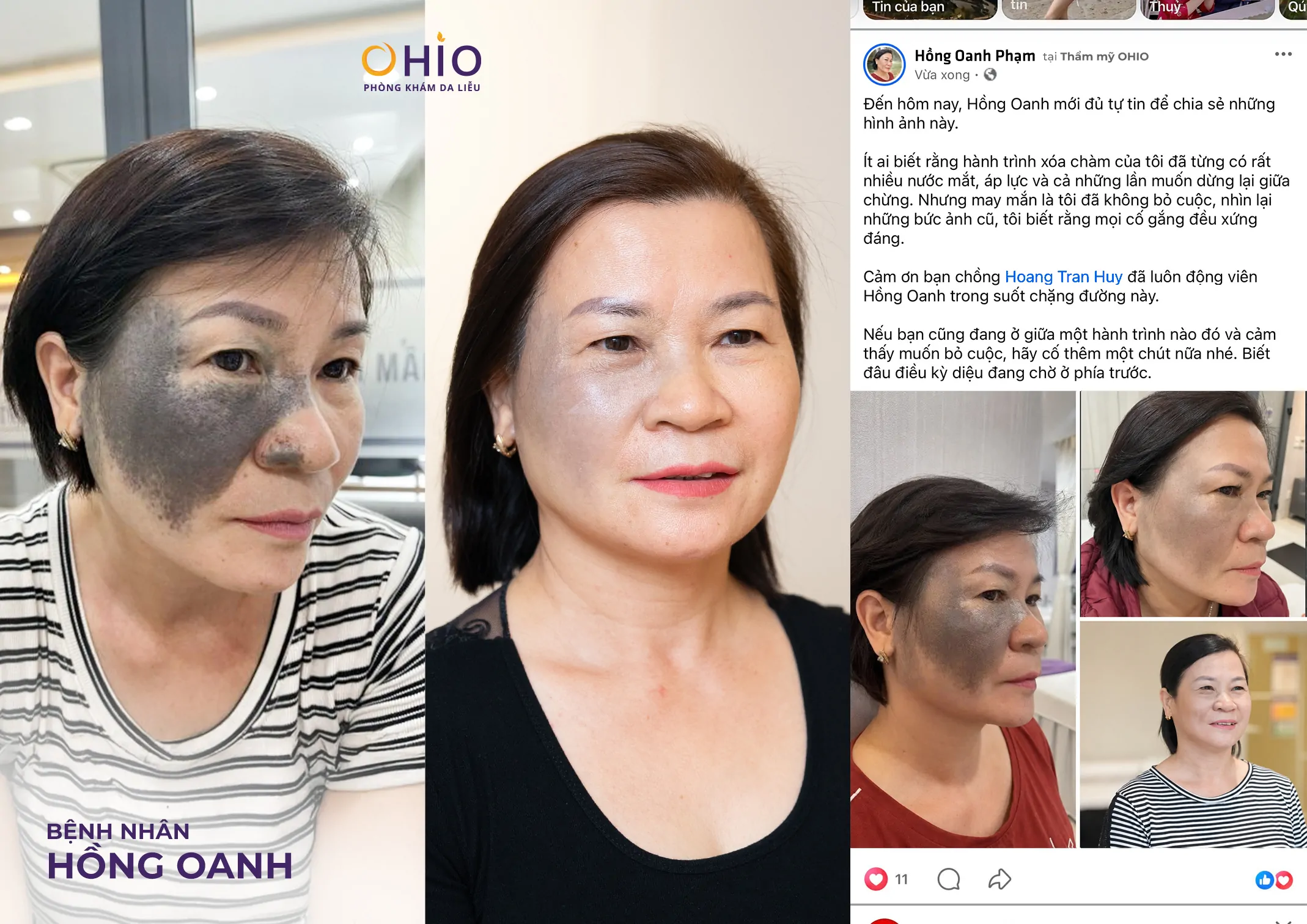 Chàm bớt OTA là gì? Nguyên nhân hình thành và phương pháp điều trị hiện nay - Phòng khám da liễu OHIO Chàm bớt OTA là gì? Nguyên nhân hình thành và phương pháp điều trị hiện nay