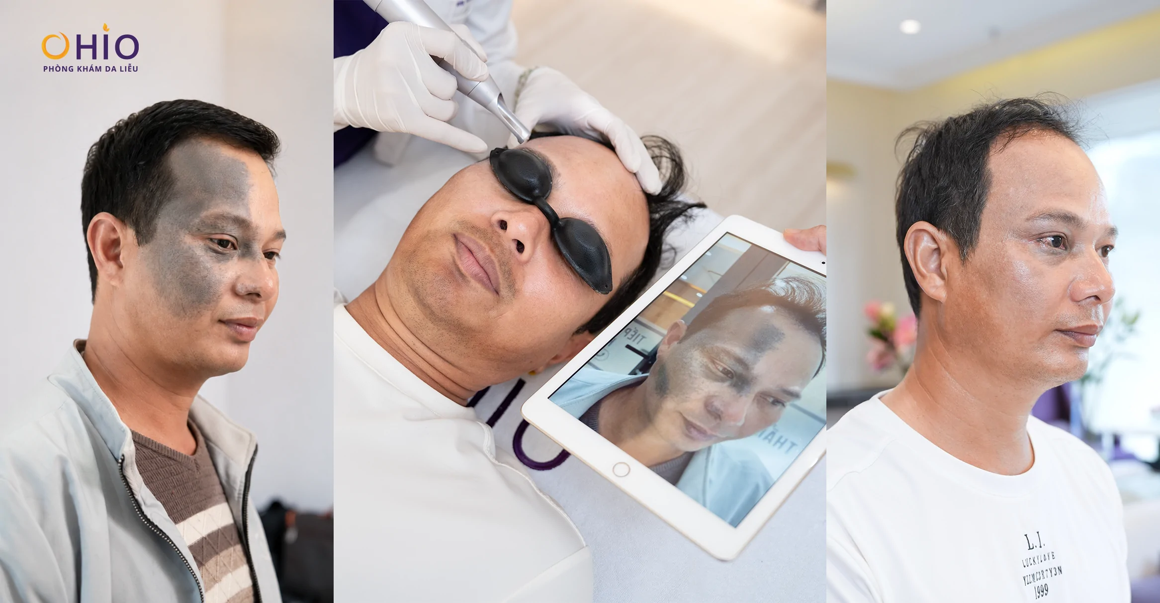 Hành trình xóa chàm bớt đầy “kỳ tích” của anh Nguyễn Văn Tập - Phòng khám da liễu OHIO Hành trình xóa chàm bớt đầy “kỳ tích” của anh Nguyễn Văn Tập