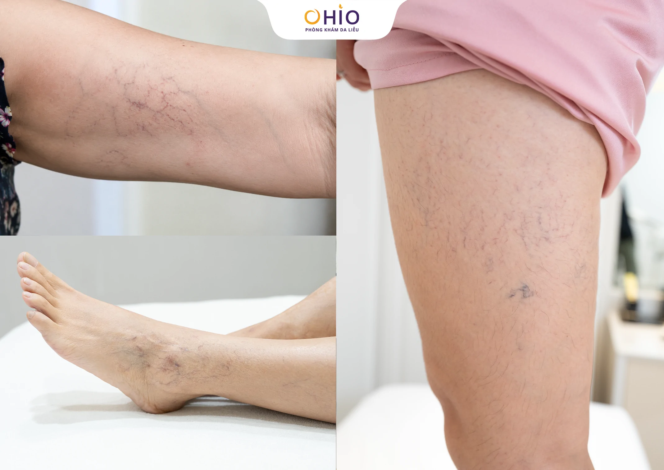 Dấu hiệu giãn mao mạch body là gì? Nguyên nhân và phương pháp điều trị - Phòng khám da liễu OHIO Dấu hiệu giãn mao mạch body là gì? Nguyên nhân và phương pháp điều trị