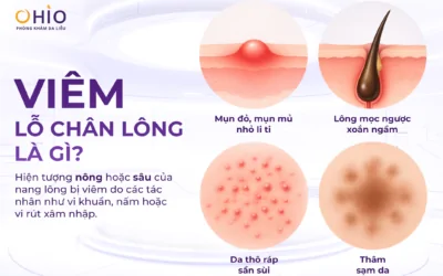 Viêm lỗ chân lông nguyên nhân do đâu? Điều trị phương pháp nào hiệu quả nhanh chóng? - Phòng khám da liễu OHIO Viêm lỗ chân lông nguyên nhân do đâu? Điều trị phương pháp nào hiệu quả nhanh chóng?