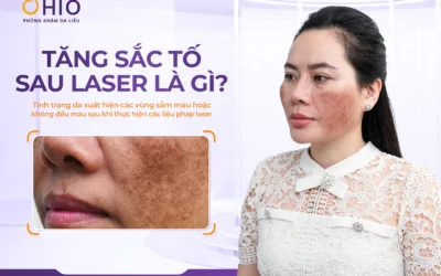 Tăng sắc tố sau laser: Vì sao da thâm sạm hơn sau điều trị và làm thế nào để khắc phục? - Phòng khám da liễu OHIO Tăng sắc tố sau laser: Vì sao da thâm sạm hơn sau điều trị và làm thế nào để khắc phục?