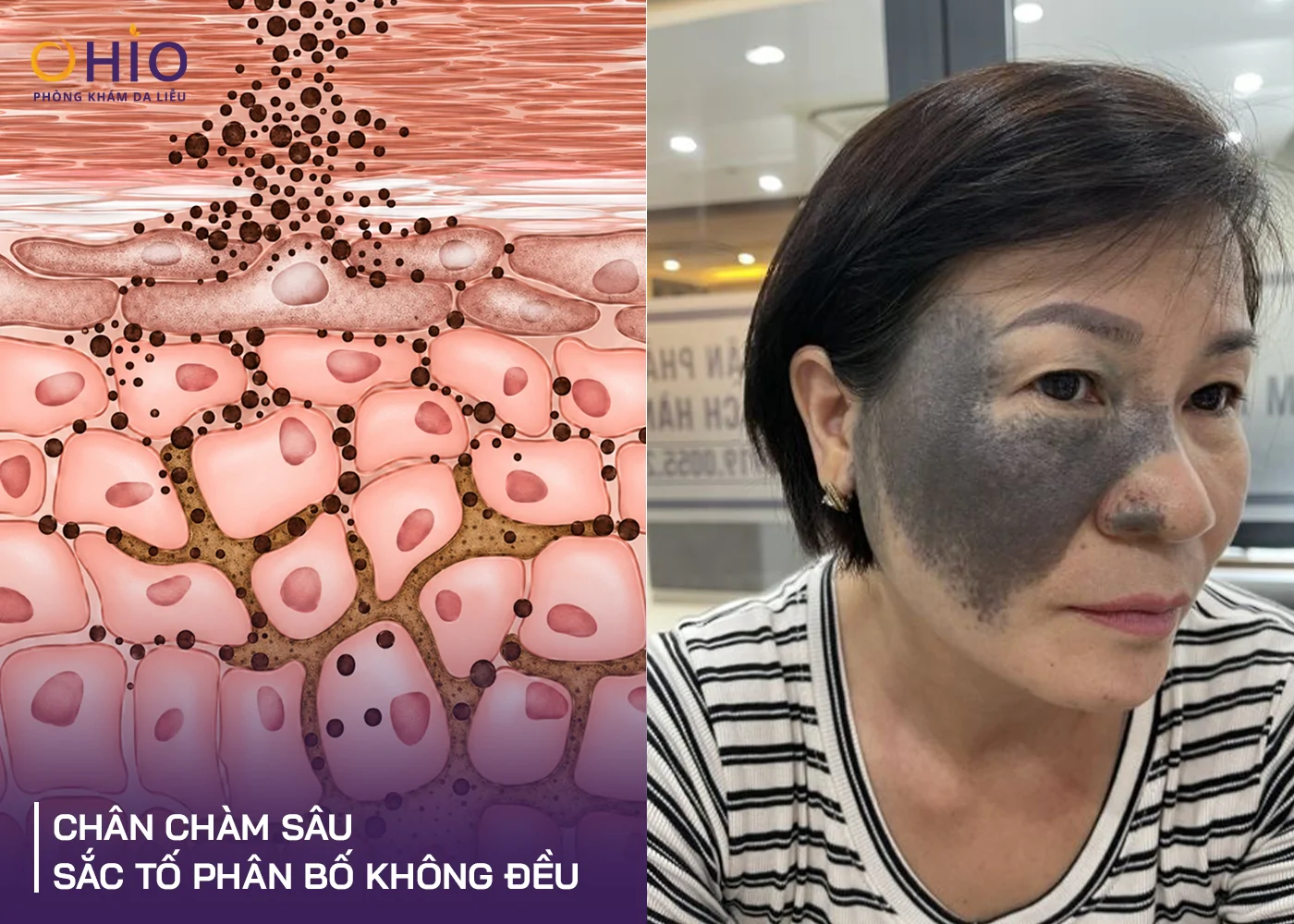 Xóa chàm bớt, U50 tạm biệt khẩu trang tự tin để mặt mộc - Phòng khám da liễu OHIO Xóa chàm bớt, U50 tạm biệt khẩu trang tự tin để mặt mộc