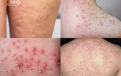 Viêm nang lông điều trị nhiều lần vẫn tái phát? BSCKI Dương Văn Lộc lý giải nguyên nhân - Phòng khám da liễu OHIO Viêm nang lông điều trị nhiều lần vẫn tái phát? BSCKI Dương Văn Lộc lý giải nguyên nhân
