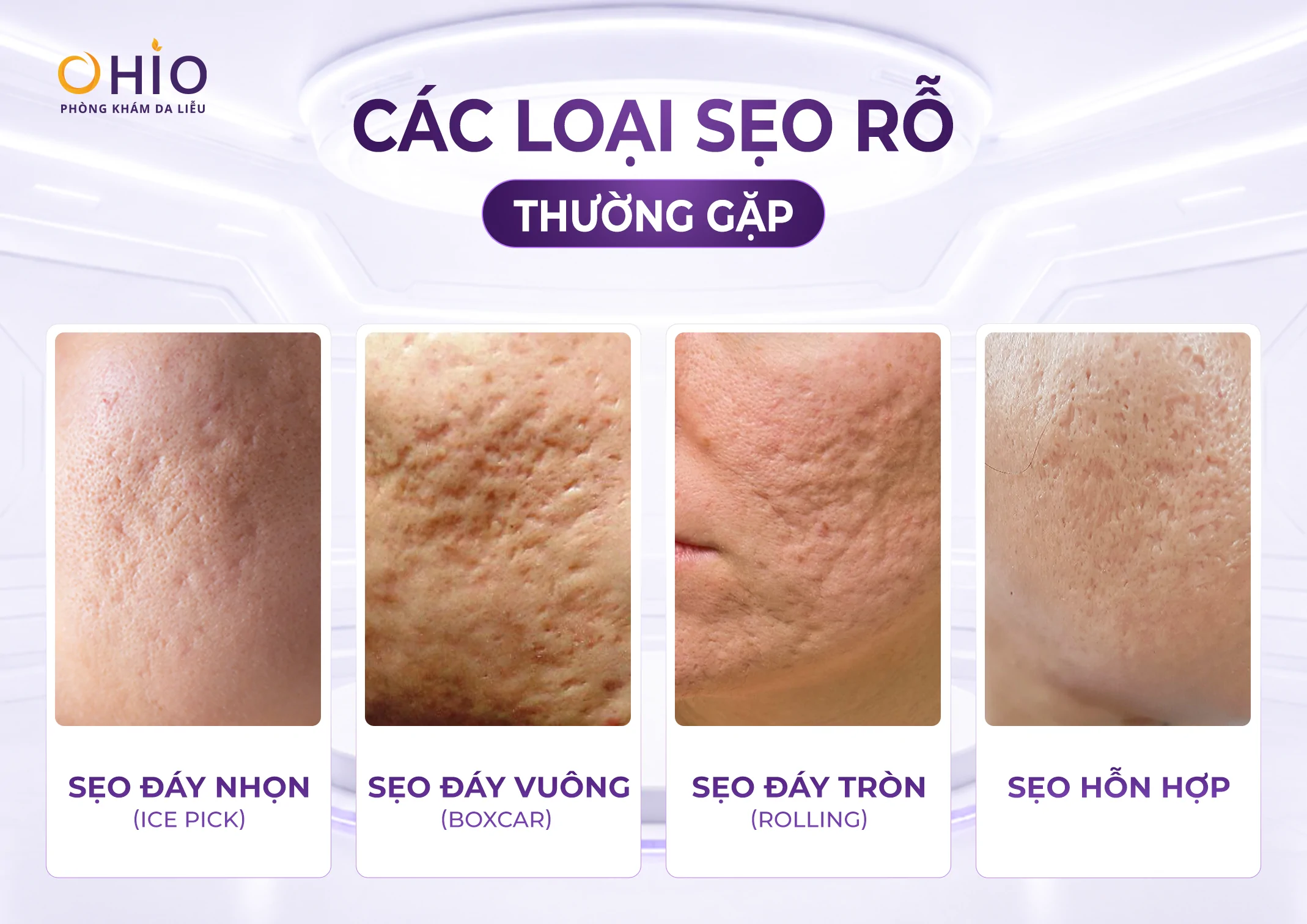 Điều trị sẹo rỗ da tại Đà Nẵng chi phí bao nhiêu? - Phòng khám da liễu OHIO Điều trị sẹo rỗ da tại Đà Nẵng chi phí bao nhiêu?
