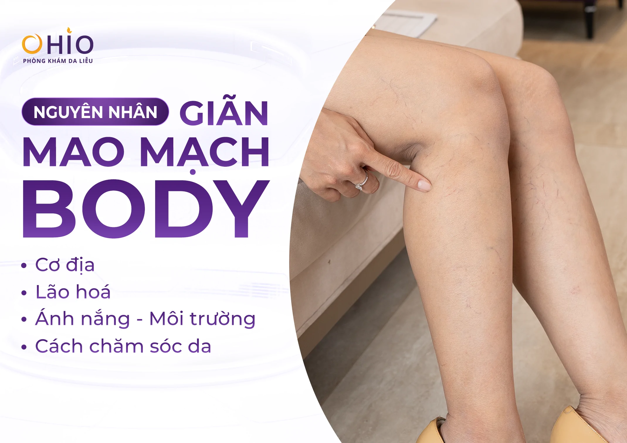 Dấu hiệu giãn mao mạch body là gì? Nguyên nhân và phương pháp điều trị - Phòng khám da liễu OHIO Dấu hiệu giãn mao mạch body là gì? Nguyên nhân và phương pháp điều trị