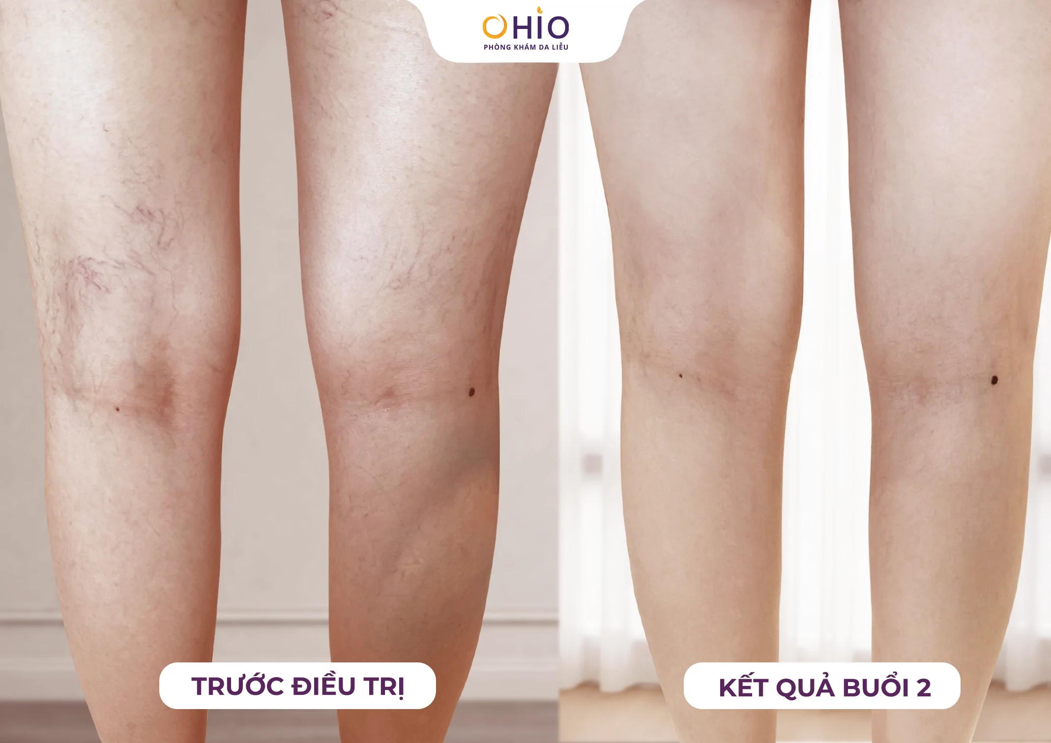 5 Năm Giãn Mao Mạch - 1 Hành trình tìm lại đôi chân đẹp - Phòng khám da liễu OHIO 5 Năm Giãn Mao Mạch - 1 Hành trình tìm lại đôi chân đẹp