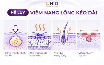 Viêm lỗ chân lông nguyên nhân do đâu? Điều trị phương pháp nào hiệu quả nhanh chóng? - Phòng khám da liễu OHIO Viêm lỗ chân lông nguyên nhân do đâu? Điều trị phương pháp nào hiệu quả nhanh chóng?