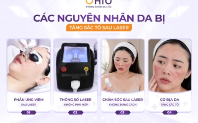 Tăng sắc tố sau laser: Vì sao da thâm sạm hơn sau điều trị và làm thế nào để khắc phục? - Phòng khám da liễu OHIO Tăng sắc tố sau laser: Vì sao da thâm sạm hơn sau điều trị và làm thế nào để khắc phục?