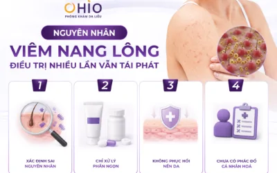 Viêm nang lông điều trị nhiều lần vẫn tái phát? BSCKI Dương Văn Lộc lý giải nguyên nhân - Phòng khám da liễu OHIO Viêm nang lông điều trị nhiều lần vẫn tái phát? BSCKI Dương Văn Lộc lý giải nguyên nhân