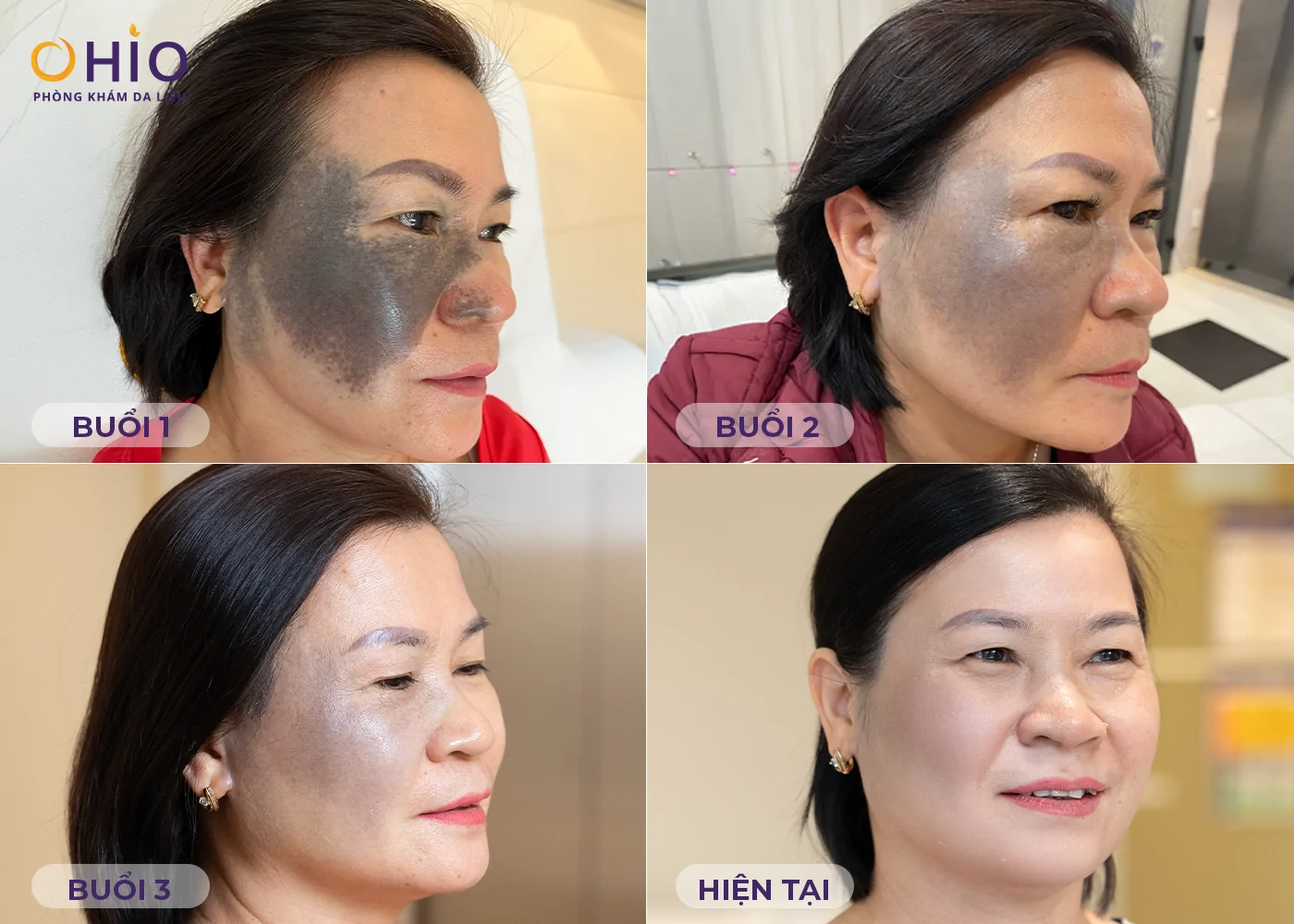 Xóa chàm bớt, U50 tạm biệt khẩu trang tự tin để mặt mộc - Phòng khám da liễu OHIO Xóa chàm bớt, U50 tạm biệt khẩu trang tự tin để mặt mộc