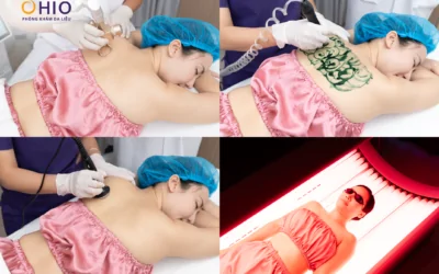 Viêm nang lông điều trị nhiều lần vẫn tái phát? BSCKI Dương Văn Lộc lý giải nguyên nhân - Phòng khám da liễu OHIO Viêm nang lông điều trị nhiều lần vẫn tái phát? BSCKI Dương Văn Lộc lý giải nguyên nhân